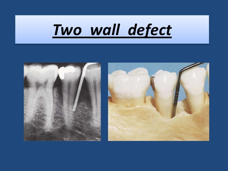 Bone Loss Bone Loss