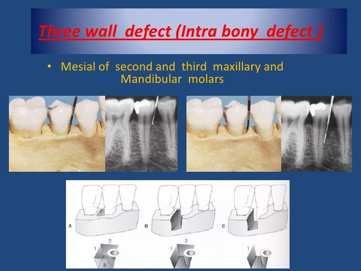 Bone Loss Bone Loss