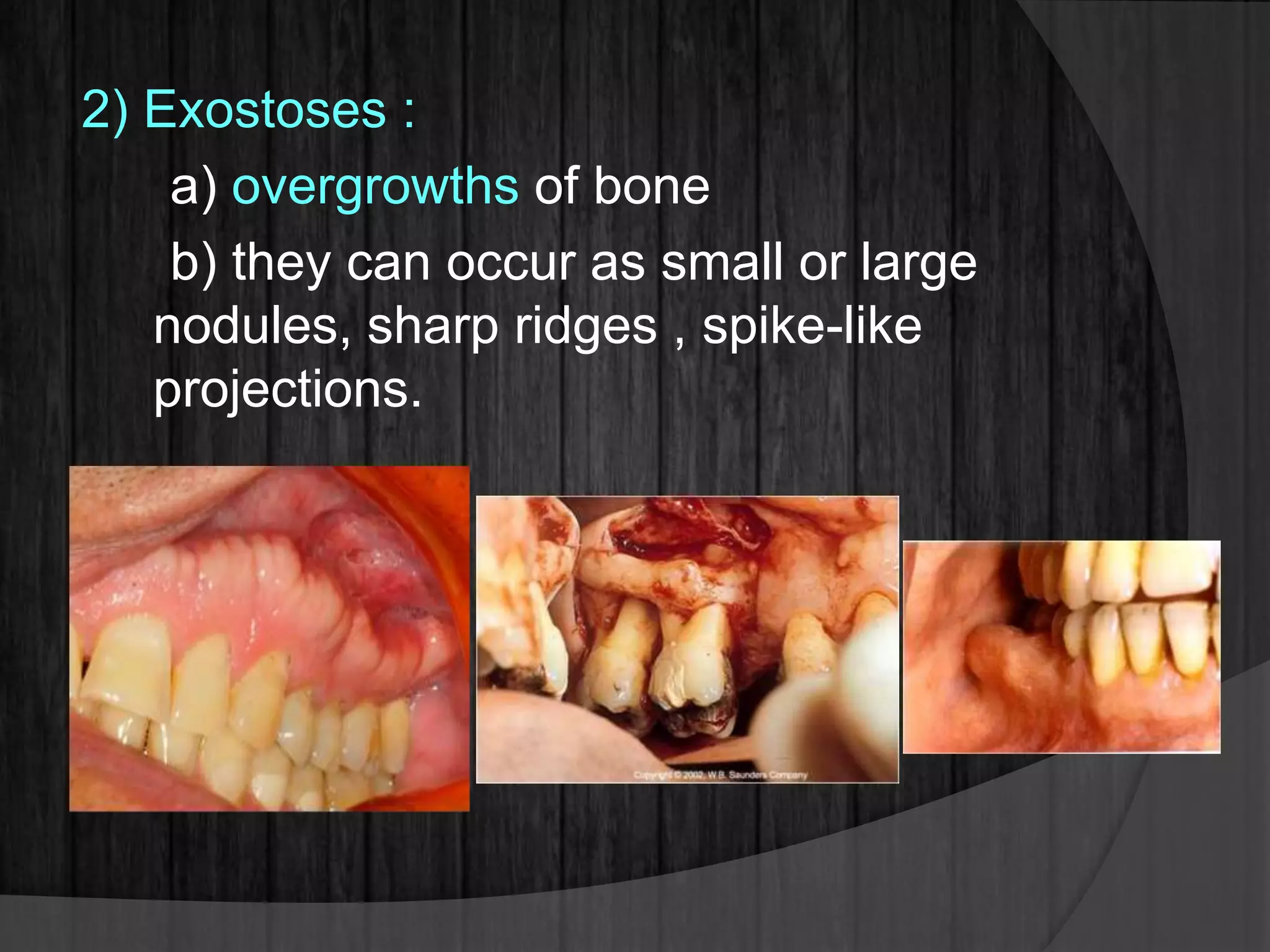 2) Exostoses :
a) overgrowths of bone
b) they can occur as small or large
nodules, sharp ridges , spike-like
projections.
 
