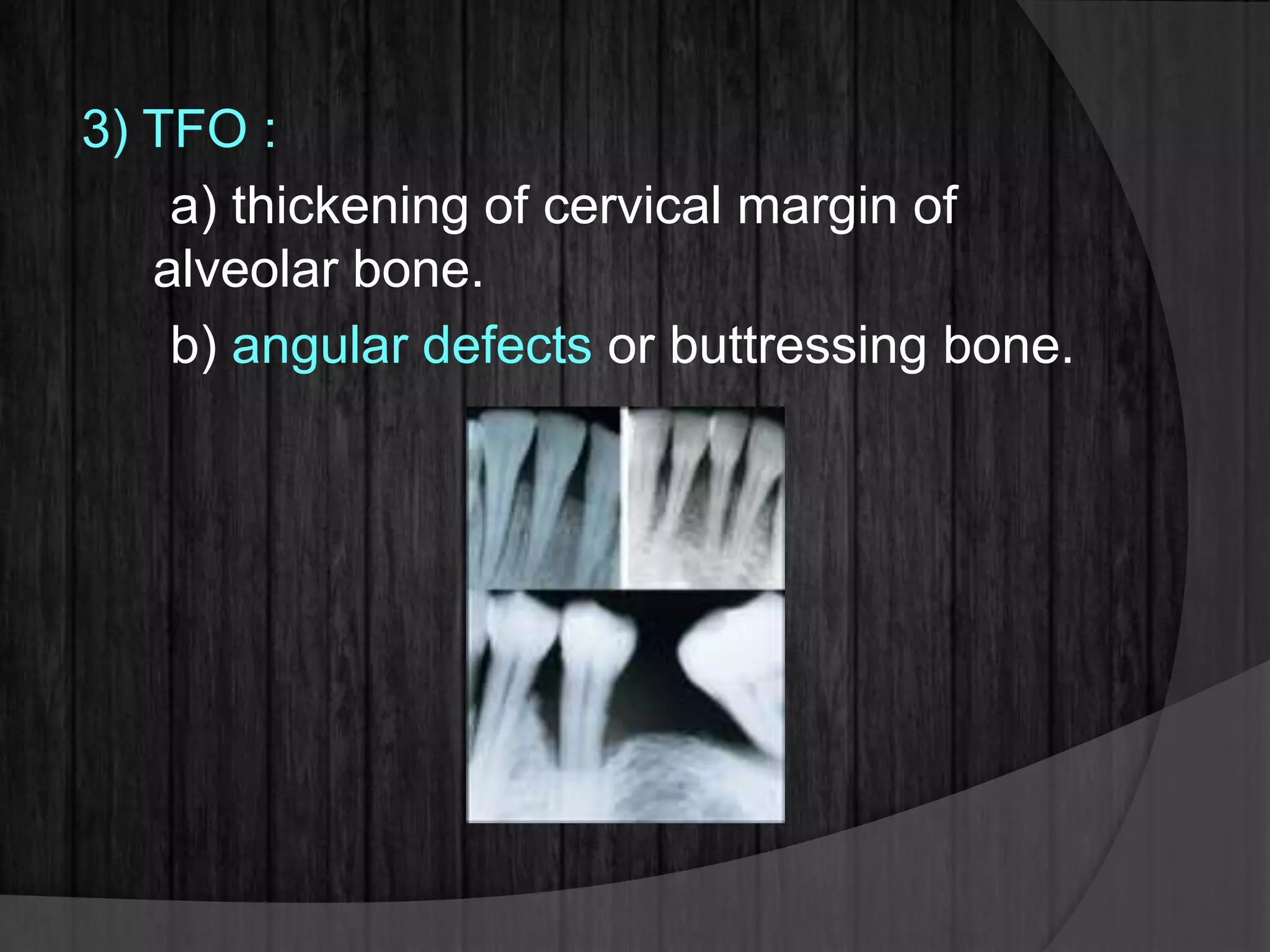 3) TFO :
a) thickening of cervical margin of
alveolar bone.
b) angular defects or buttressing bone.
 