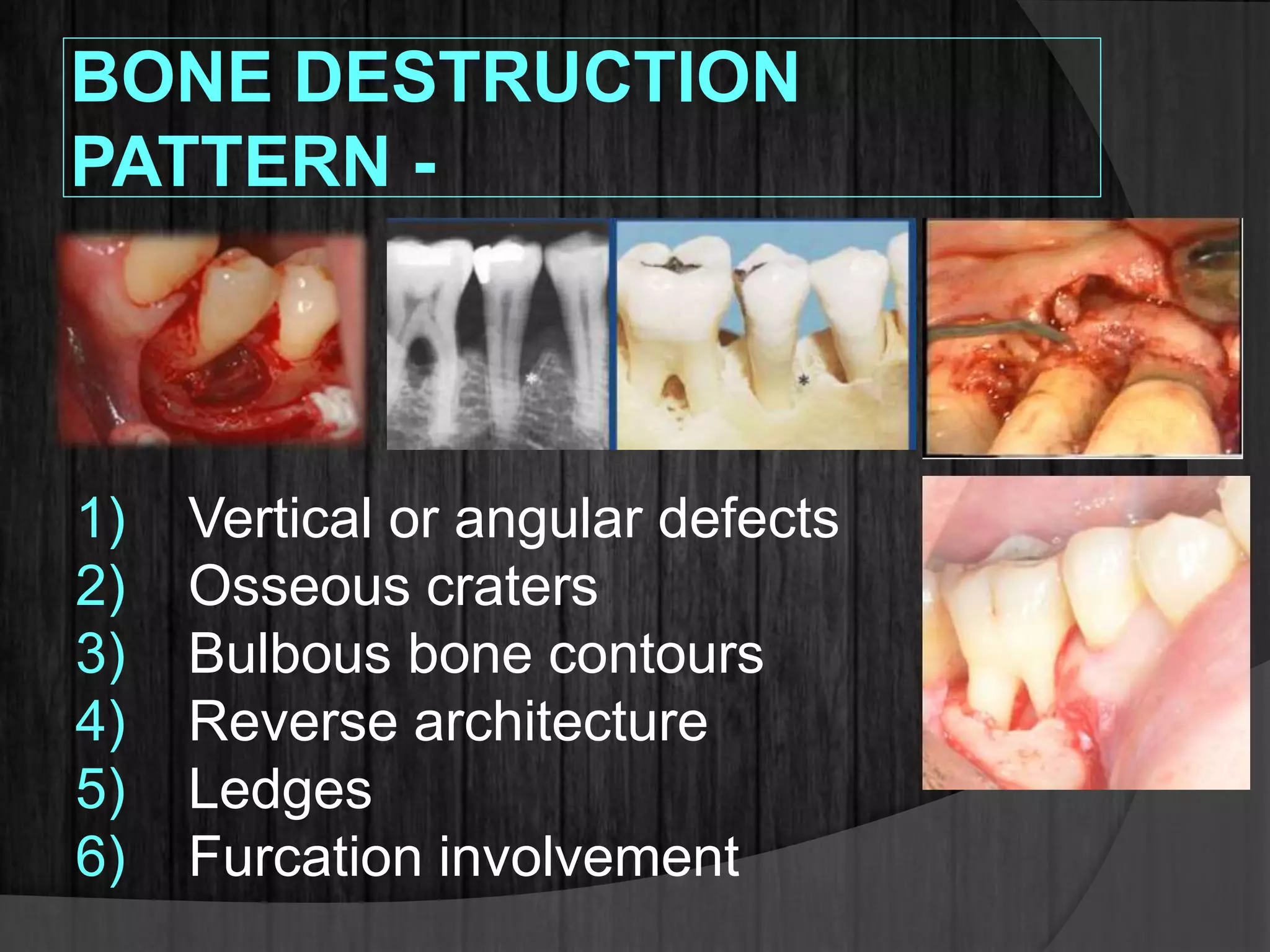 BONE DESTRUCTION
PATTERN -
1) Vertical or angular defects
2) Osseous craters
3) Bulbous bone contours
4) Reverse architecture
5) Ledges
6) Furcation involvement
 