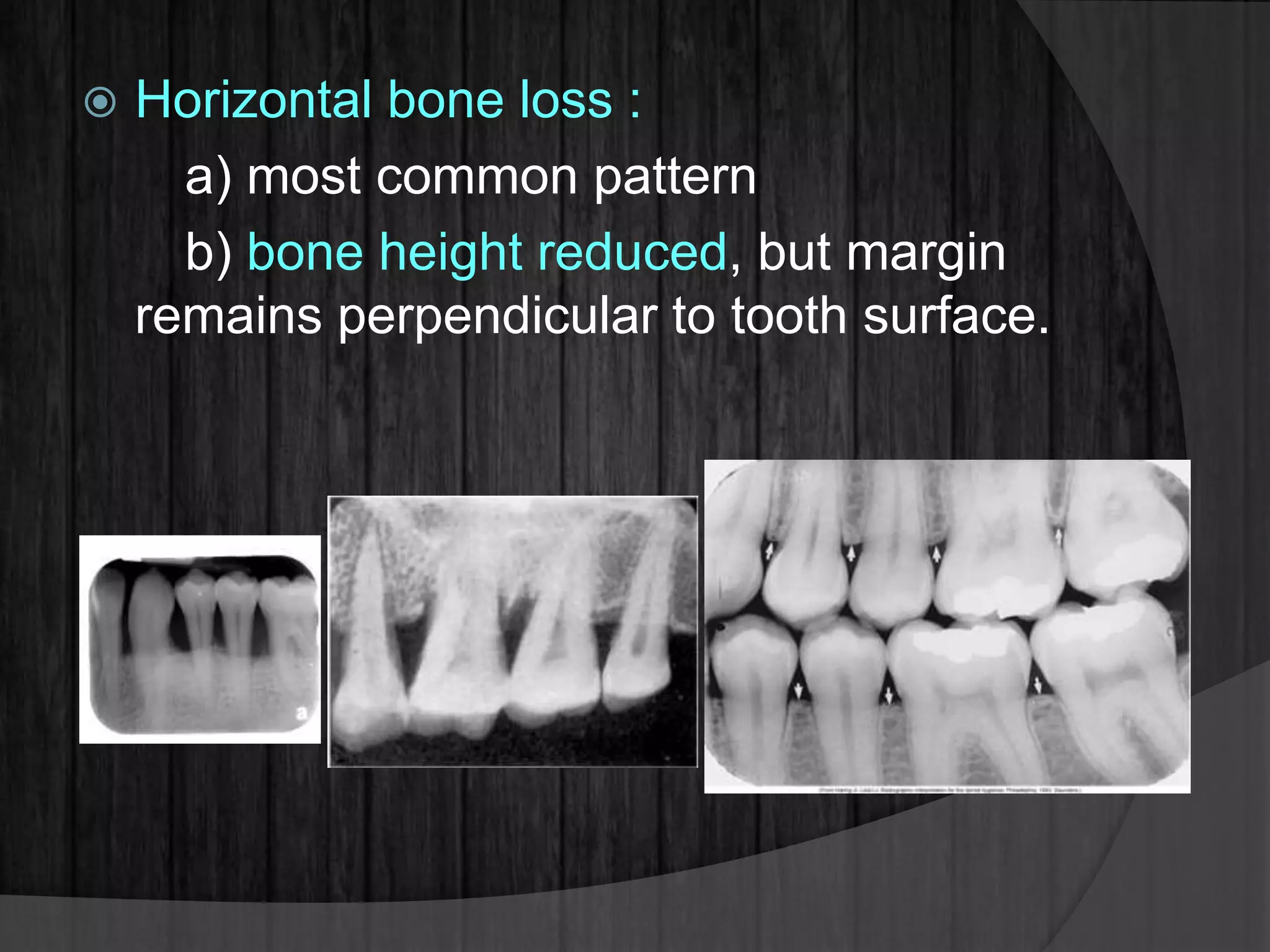  Horizontal bone loss :
a) most common pattern
b) bone height reduced, but margin
remains perpendicular to tooth surface.
 