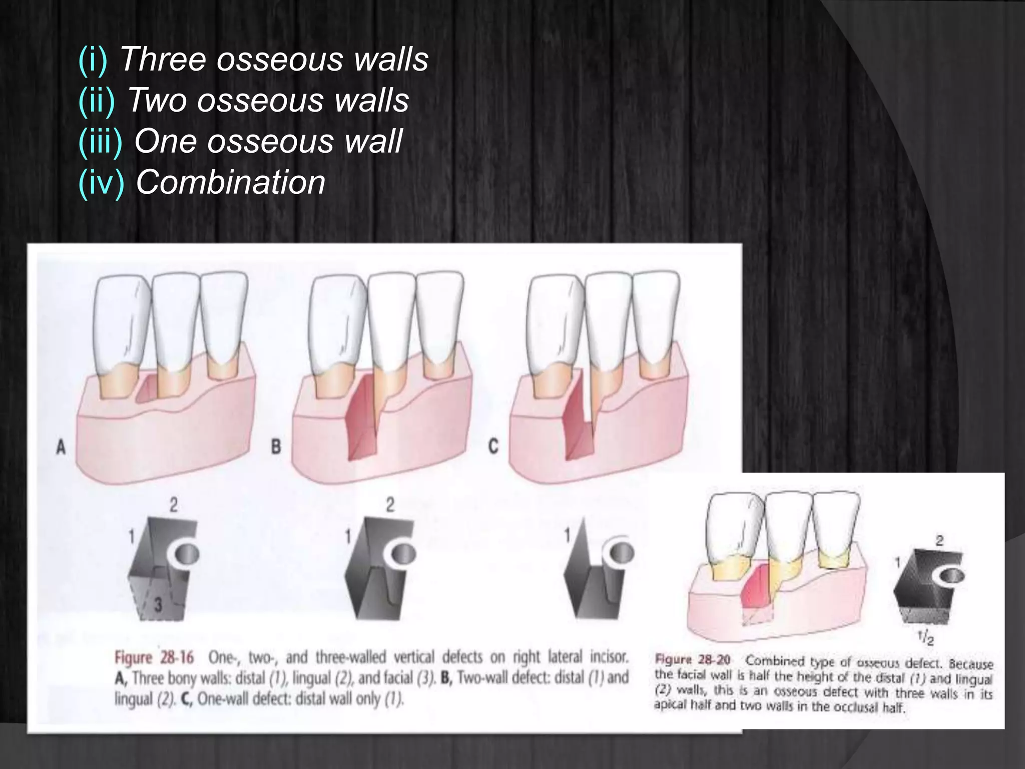 (i) Three osseous walls
(ii) Two osseous walls
(iii) One osseous wall
(iv) Combination
 