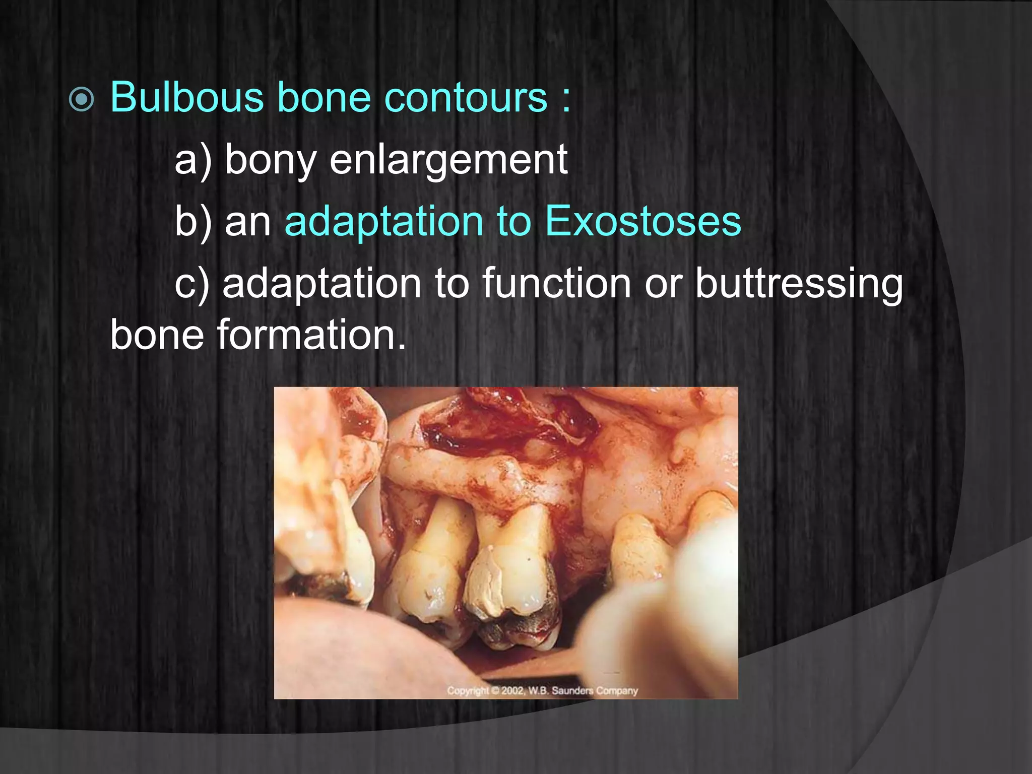  Bulbous bone contours :
a) bony enlargement
b) an adaptation to Exostoses
c) adaptation to function or buttressing
bone formation.
 