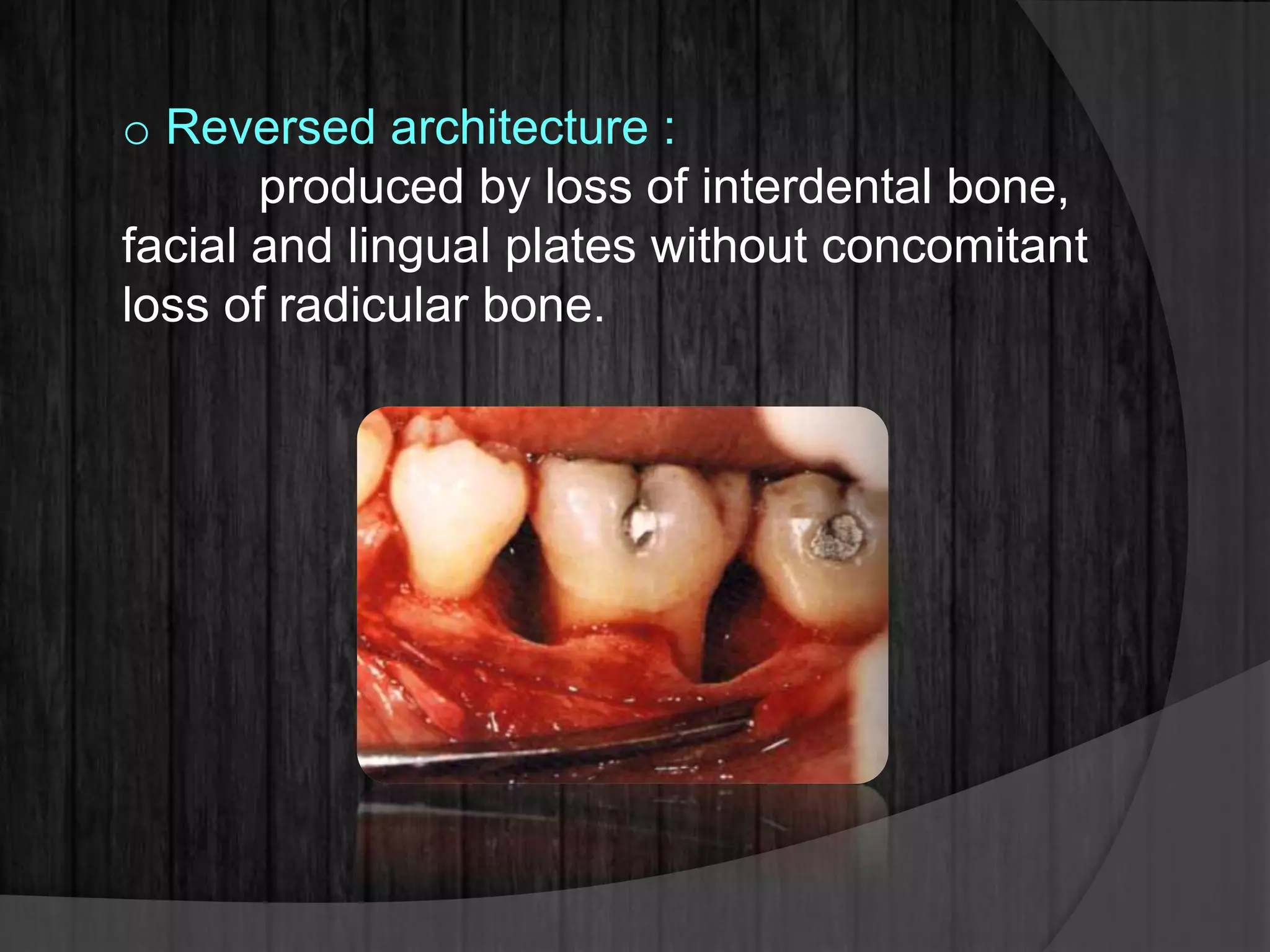 o Reversed architecture :
produced by loss of interdental bone,
facial and lingual plates without concomitant
loss of radicular bone.
 