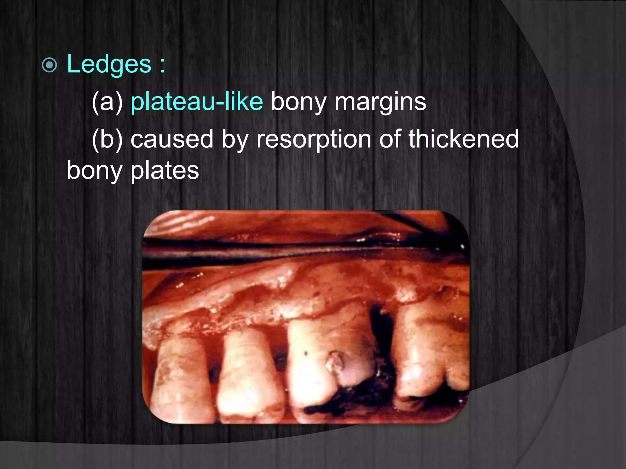  Ledges :
(a) plateau-like bony margins
(b) caused by resorption of thickened
bony plates
 