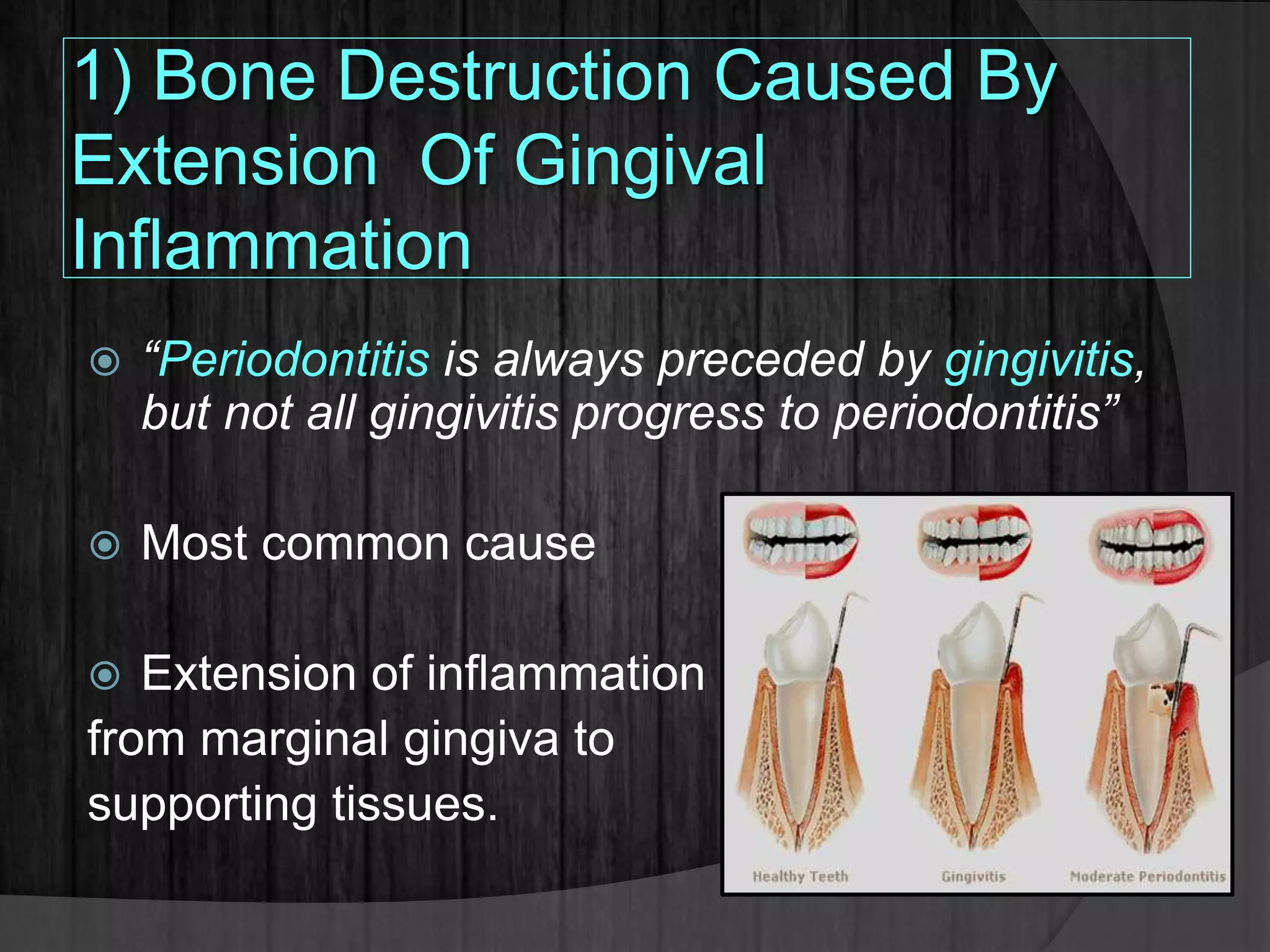 1) Bone Destruction Caused By
Extension Of Gingival
Inflammation
 “Periodontitis is always preceded by gingivitis,
but not all gingivitis progress to periodontitis”
 Most common cause
 Extension of inflammation
from marginal gingiva to
supporting tissues.
 