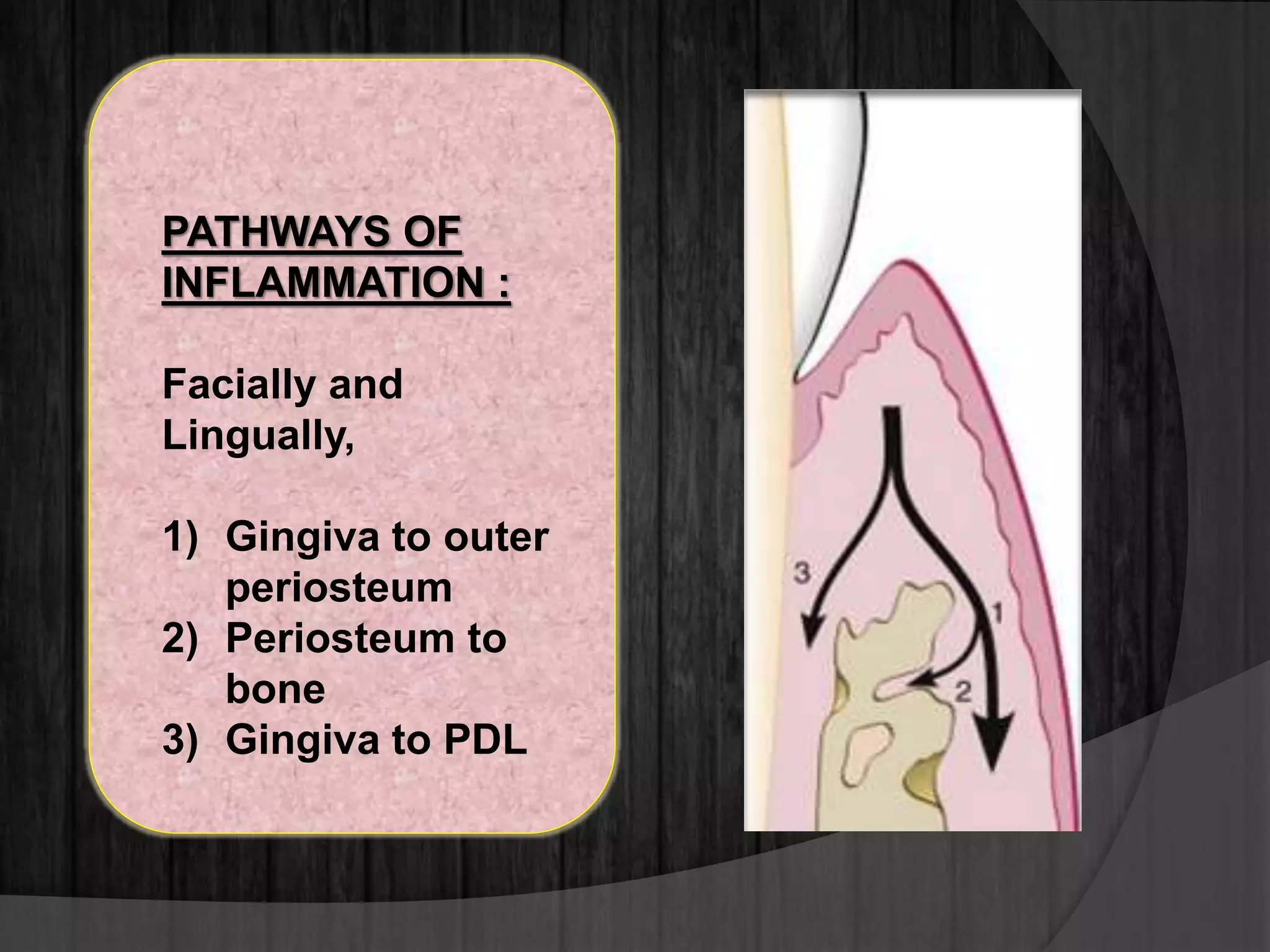 PATHWAYS OF
INFLAMMATION :
Facially and
Lingually,
1) Gingiva to outer
periosteum
2) Periosteum to
bone
3) Gingiva to PDL
 