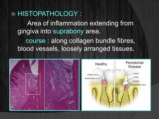 HISTOPATHOLOGY :
Area of inflammation extending from
gingiva into suprabony area.
course : along collagen bundle fibres,
blood vessels, loosely arranged tissues.
 