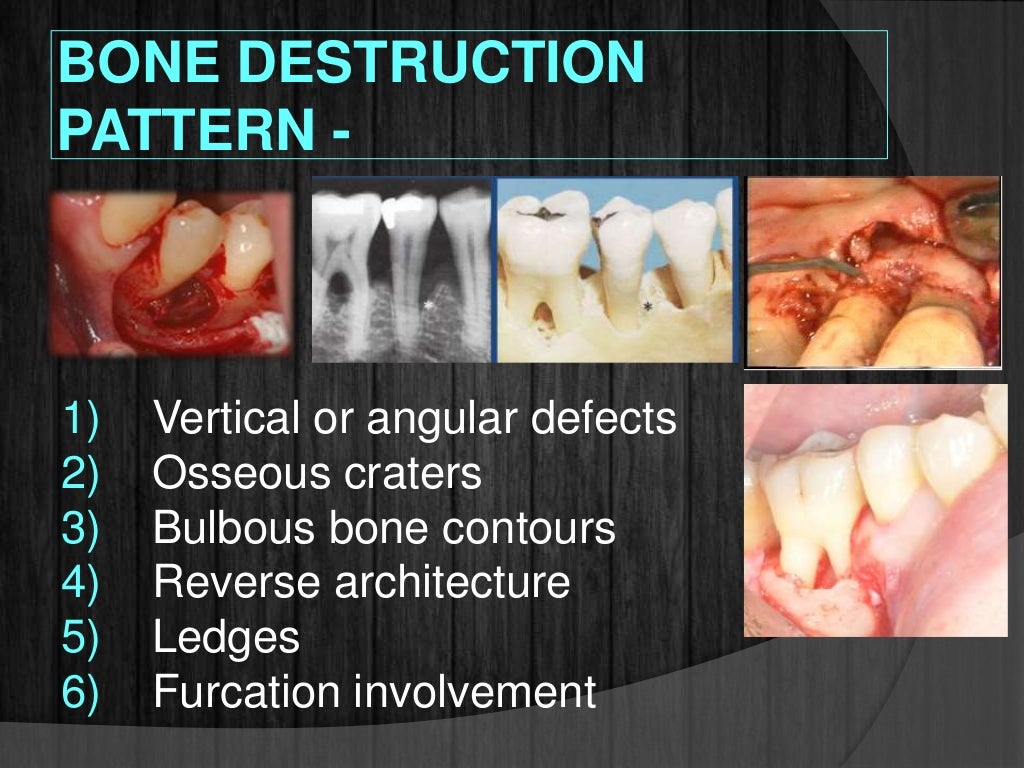 Bone loss and patterns of bone destruction