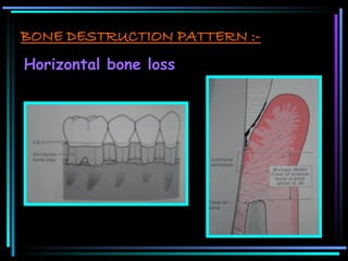 BONE LOSS & patterns of Bone destruction | PPT