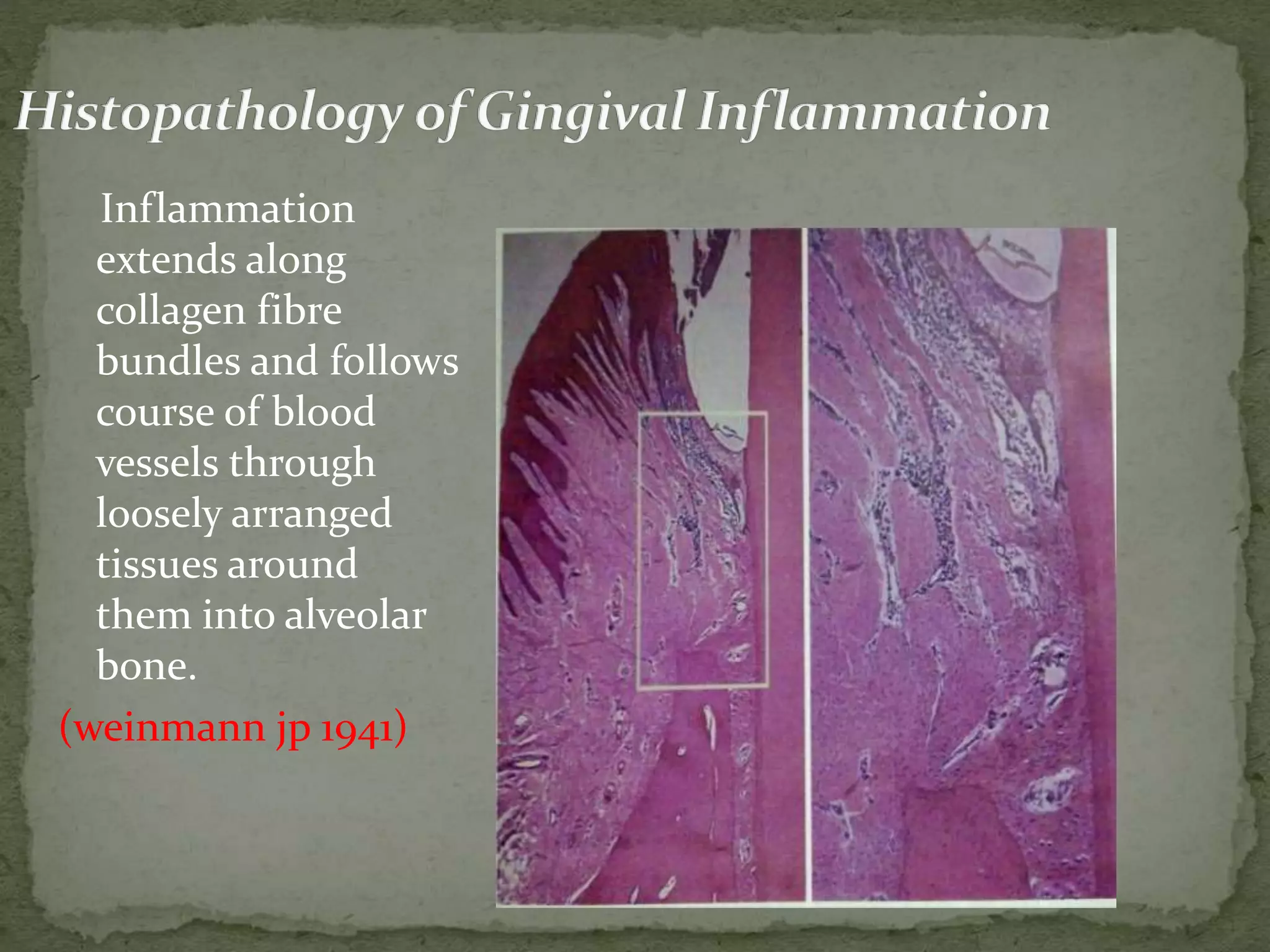 Inflammation
extends along
collagen fibre
bundles and follows
course of blood
vessels through
loosely arranged
tissues around
them into alveolar
bone.
(weinmann jp 1941)
 