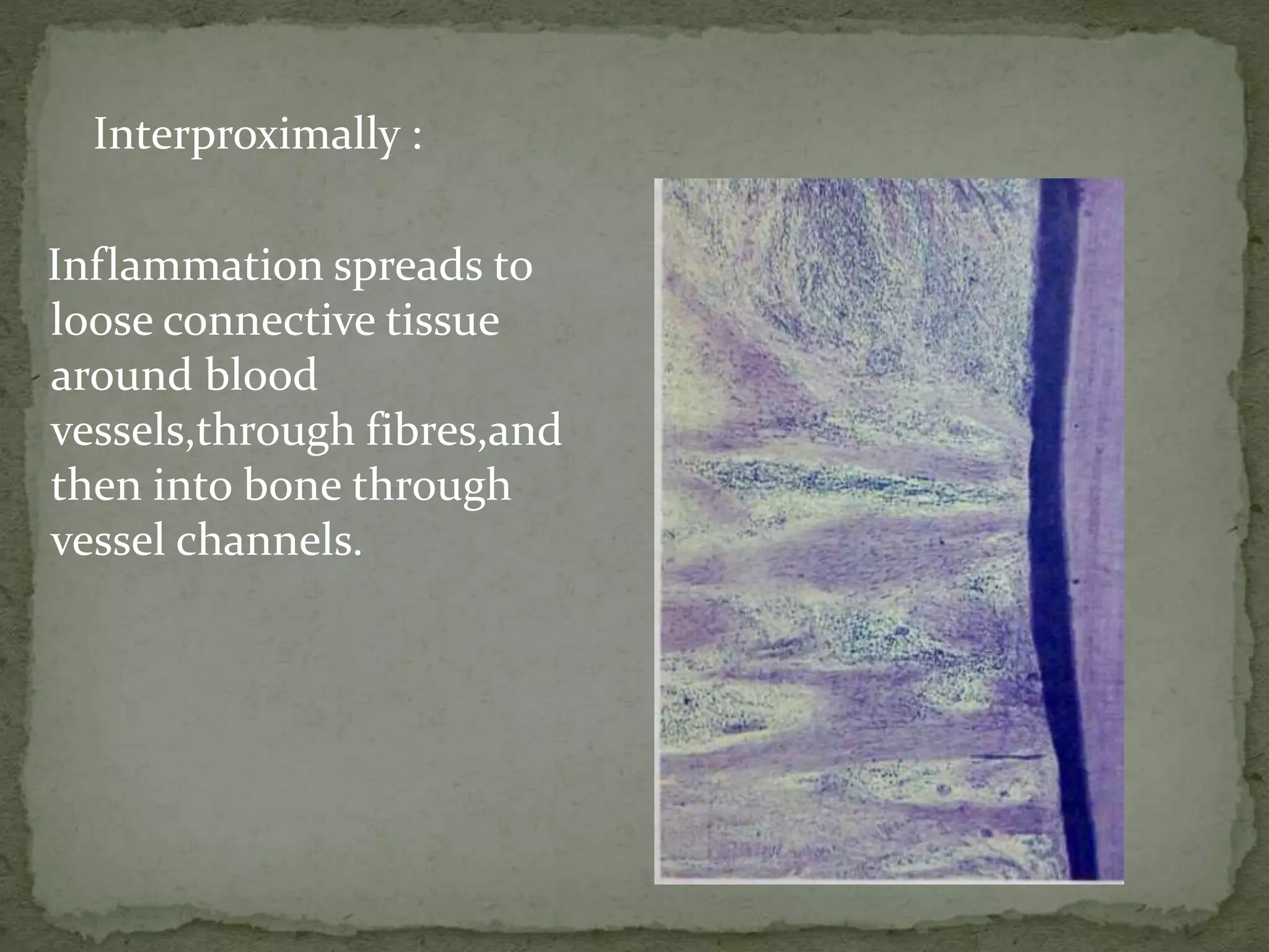 Interproximally :
Inflammation spreads to
loose connective tissue
around blood
vessels,through fibres,and
then into bone through
vessel channels.
 