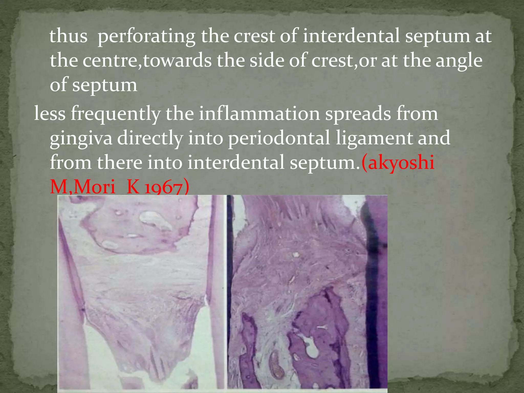 thus perforating the crest of interdental septum at
the centre,towards the side of crest,or at the angle
of septum
less frequently the inflammation spreads from
gingiva directly into periodontal ligament and
from there into interdental septum.(akyoshi
M,Mori K 1967)
 