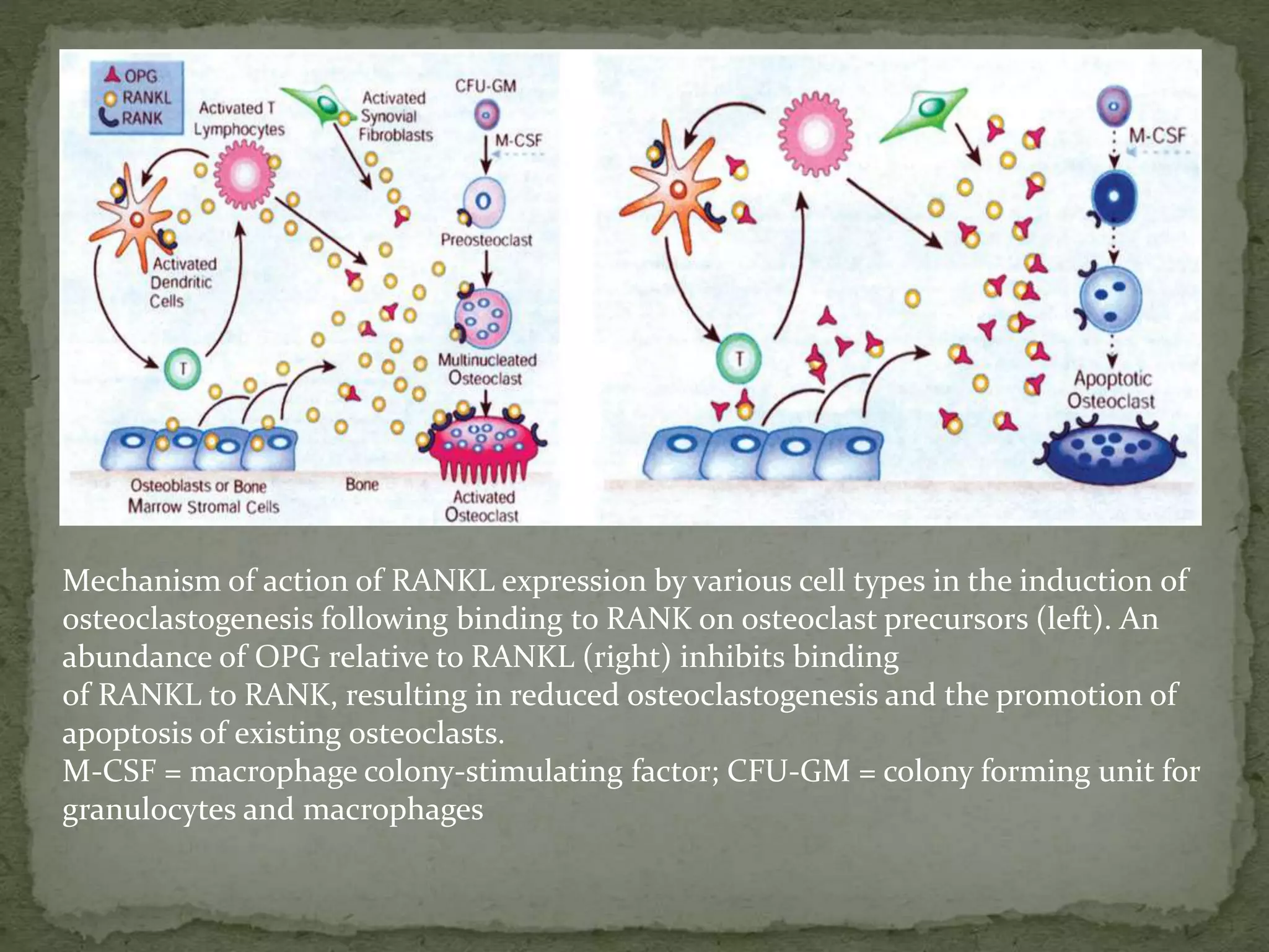Mechanism of action of RANKL expression by various cell types in the induction of
osteoclastogenesis following binding to RANK on osteoclast precursors (left). An
abundance of OPG relative to RANKL (right) inhibits binding
of RANKL to RANK, resulting in reduced osteoclastogenesis and the promotion of
apoptosis of existing osteoclasts.
M-CSF = macrophage colony-stimulating factor; CFU-GM = colony forming unit for
granulocytes and macrophages
 