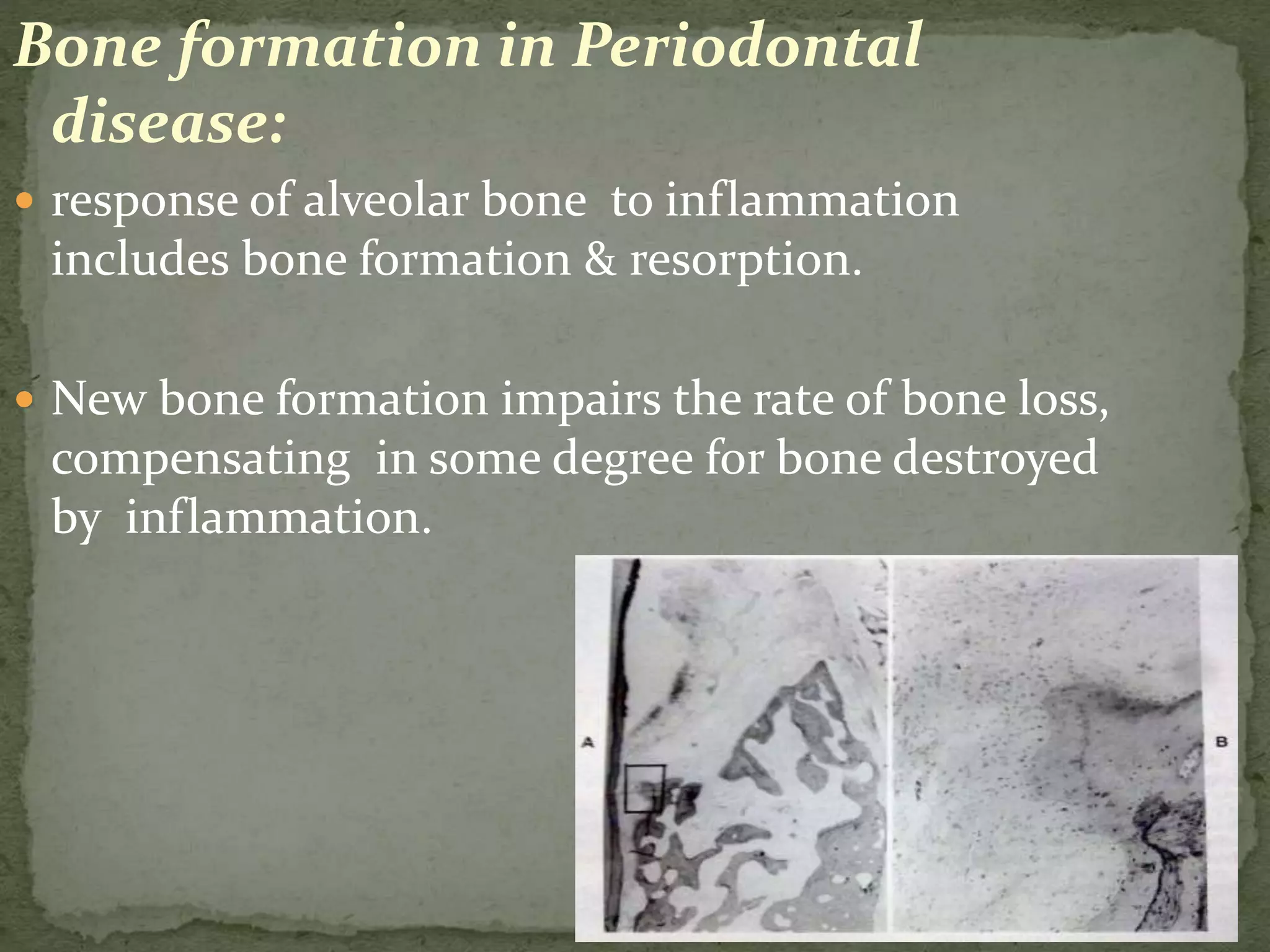 Bone formation in Periodontal
disease:
 response of alveolar bone to inflammation
includes bone formation & resorption.
 New bone formation impairs the rate of bone loss,
compensating in some degree for bone destroyed
by inflammation.
 