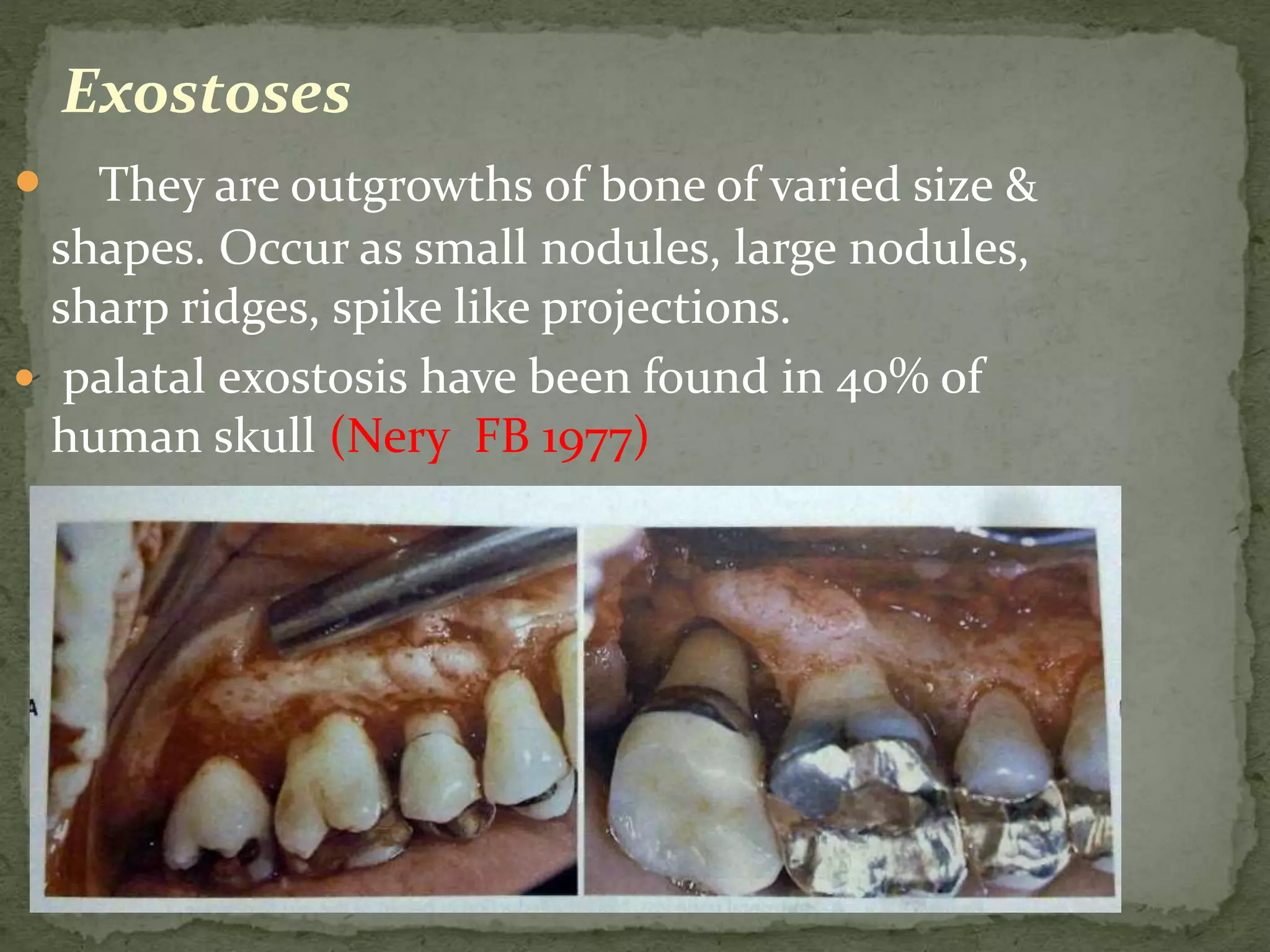 Exostoses
 They are outgrowths of bone of varied size &
shapes. Occur as small nodules, large nodules,
sharp ridges, spike like projections.
 palatal exostosis have been found in 40% of
human skull (Nery FB 1977)
 