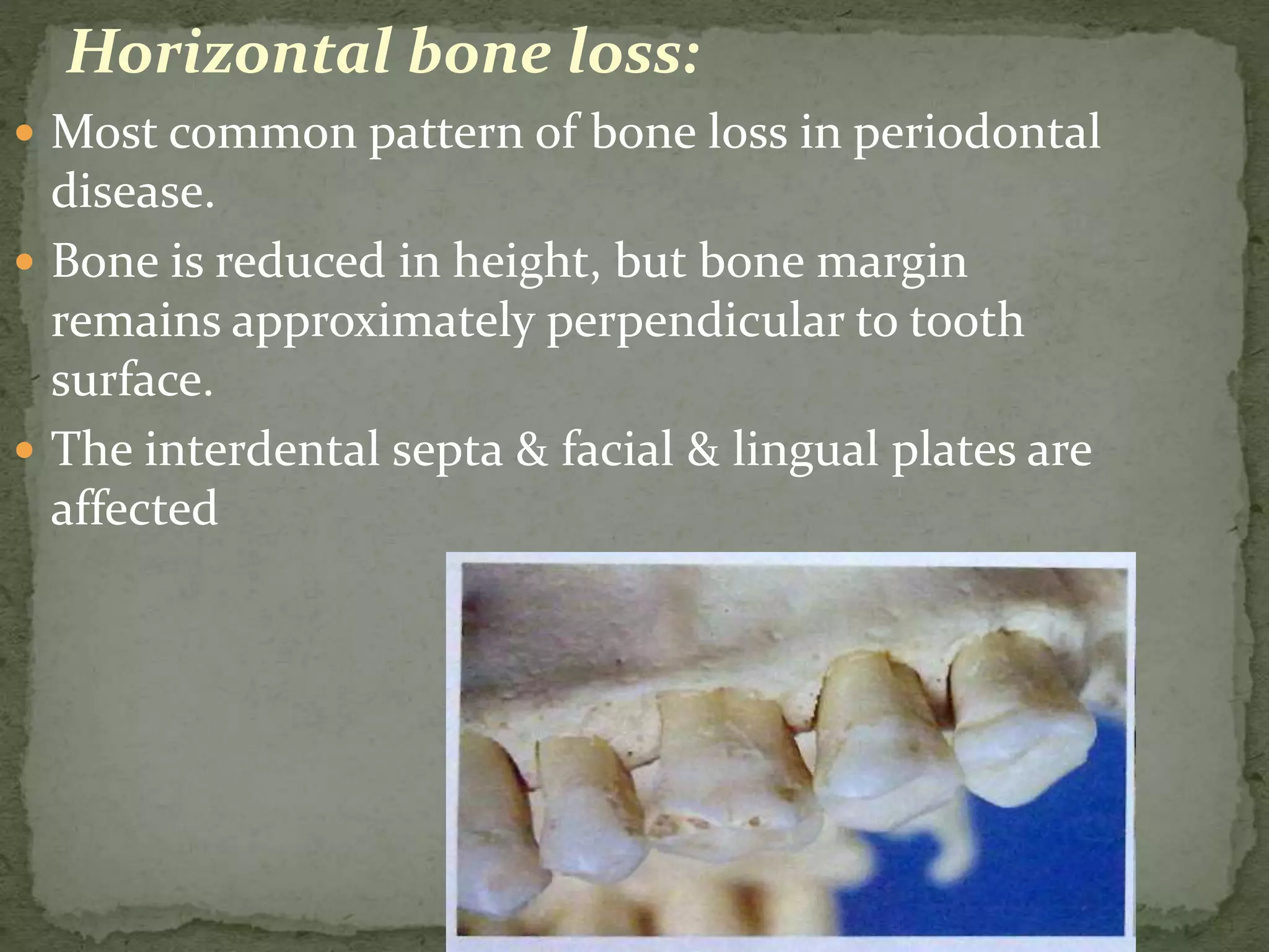 Horizontal bone loss:
 Most common pattern of bone loss in periodontal
disease.
 Bone is reduced in height, but bone margin
remains approximately perpendicular to tooth
surface.
 The interdental septa & facial & lingual plates are
affected
 