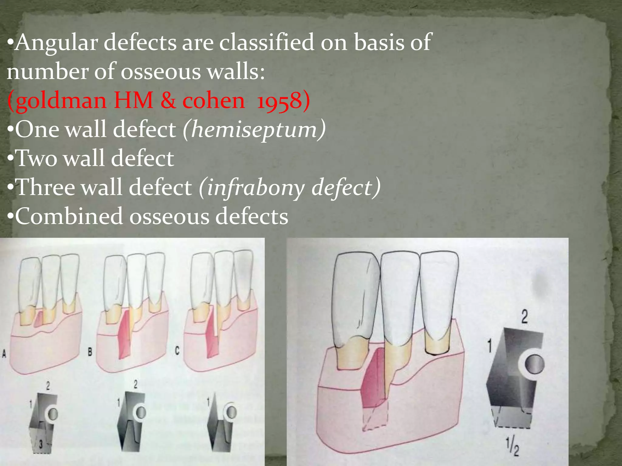 •Angular defects are classified on basis of
number of osseous walls:
(goldman HM & cohen 1958)
•One wall defect (hemiseptum)
•Two wall defect
•Three wall defect (infrabony defect)
•Combined osseous defects
 