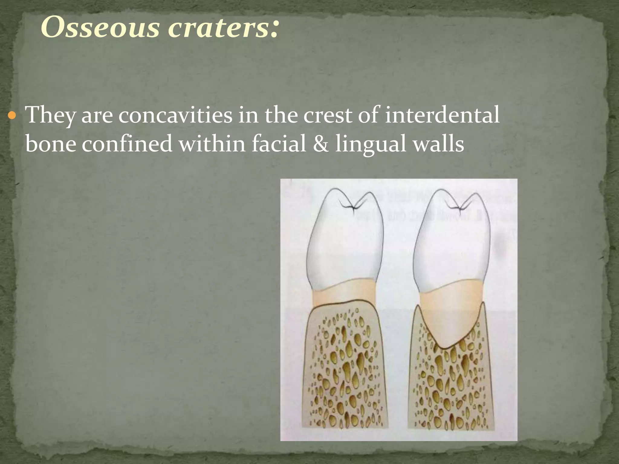 Osseous craters:
 They are concavities in the crest of interdental
bone confined within facial & lingual walls
 