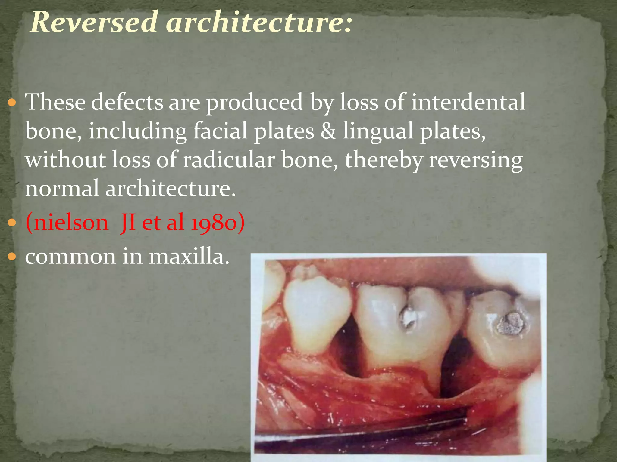 Reversed architecture:
 These defects are produced by loss of interdental
bone, including facial plates & lingual plates,
without loss of radicular bone, thereby reversing
normal architecture.
 (nielson JI et al 1980)
 common in maxilla.
 