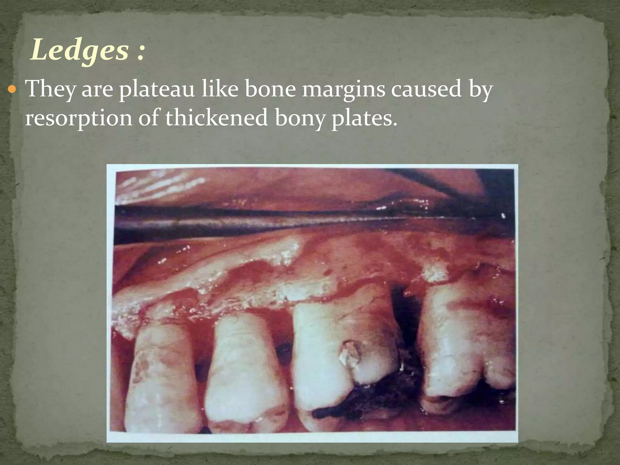 Ledges :
 They are plateau like bone margins caused by
resorption of thickened bony plates.
 
