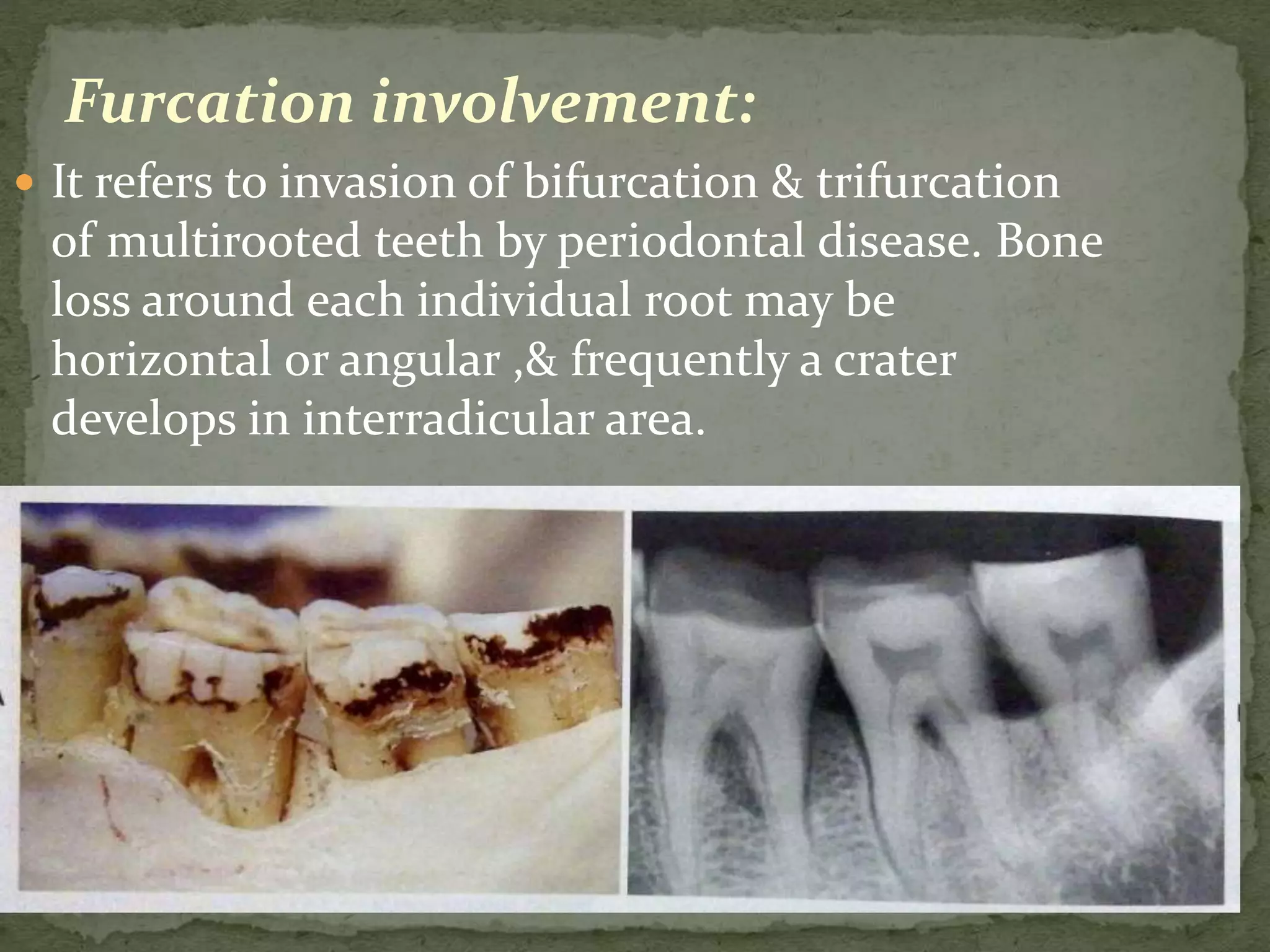 Furcation involvement:
 It refers to invasion of bifurcation & trifurcation
of multirooted teeth by periodontal disease. Bone
loss around each individual root may be
horizontal or angular ,& frequently a crater
develops in interradicular area.
 
