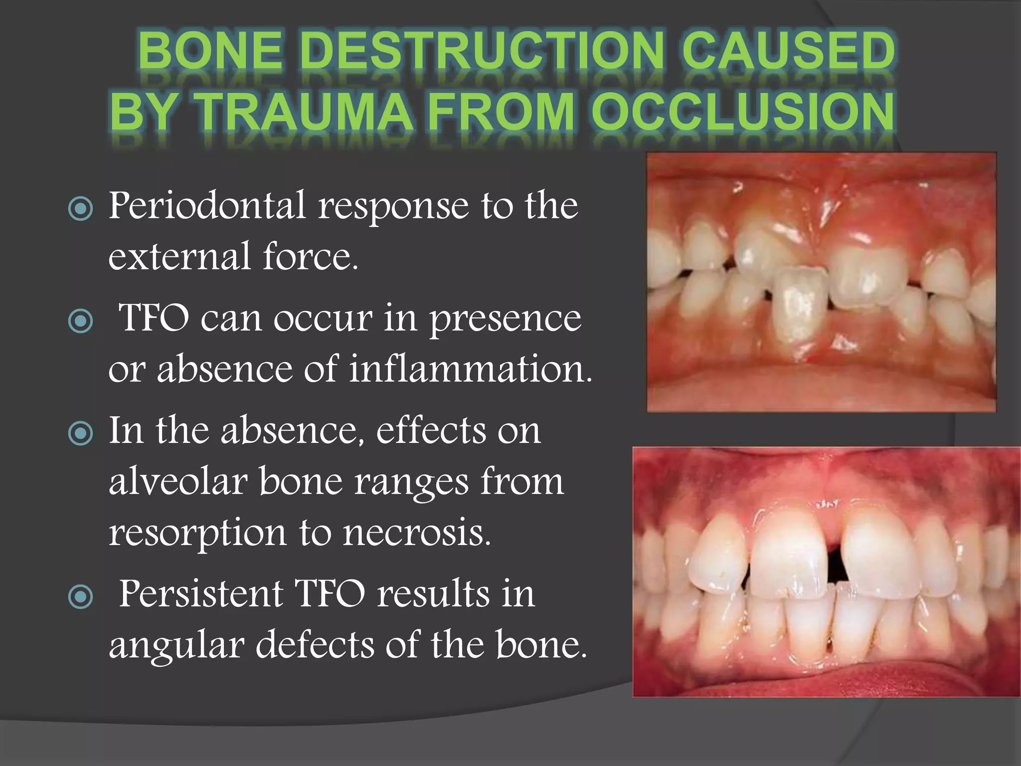 BONE DESTRUCTION CAUSED
BY TRAUMA FROM OCCLUSION
 Periodontal response to the
external force.
 TFO can occur in presence
or absence of inflammation.
 In the absence, effects on
alveolar bone ranges from
resorption to necrosis.
 Persistent TFO results in
angular defects of the bone.
 