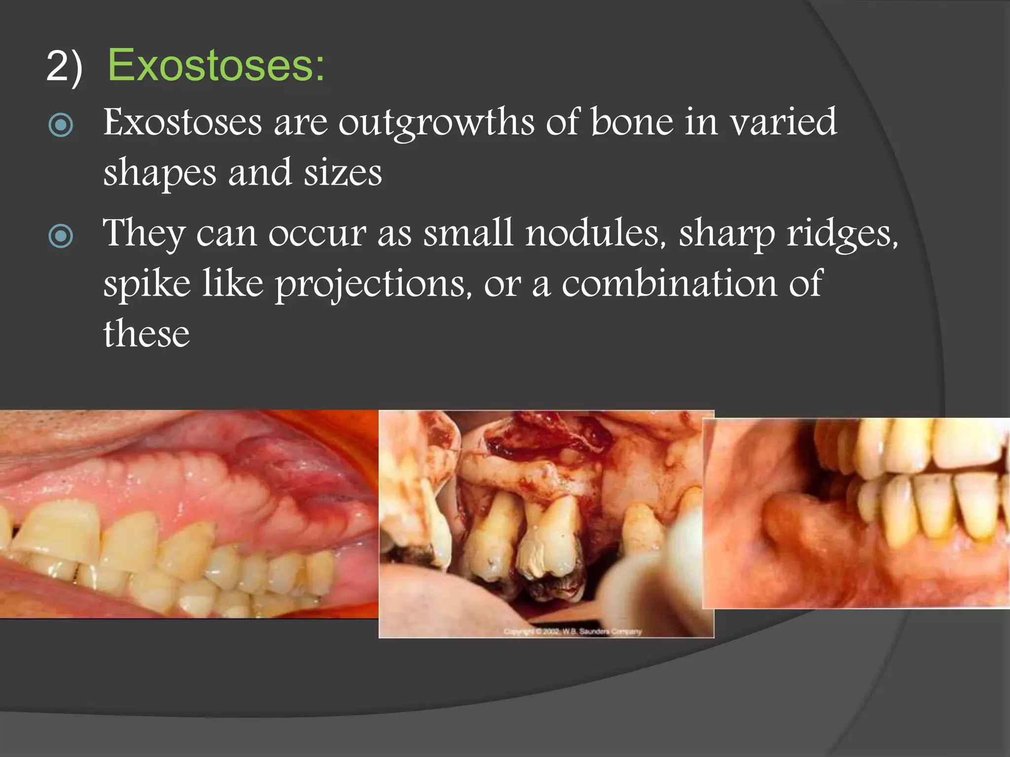 2) Exostoses:
 Exostoses are outgrowths of bone in varied
shapes and sizes
 They can occur as small nodules, sharp ridges,
spike like projections, or a combination of
these
 