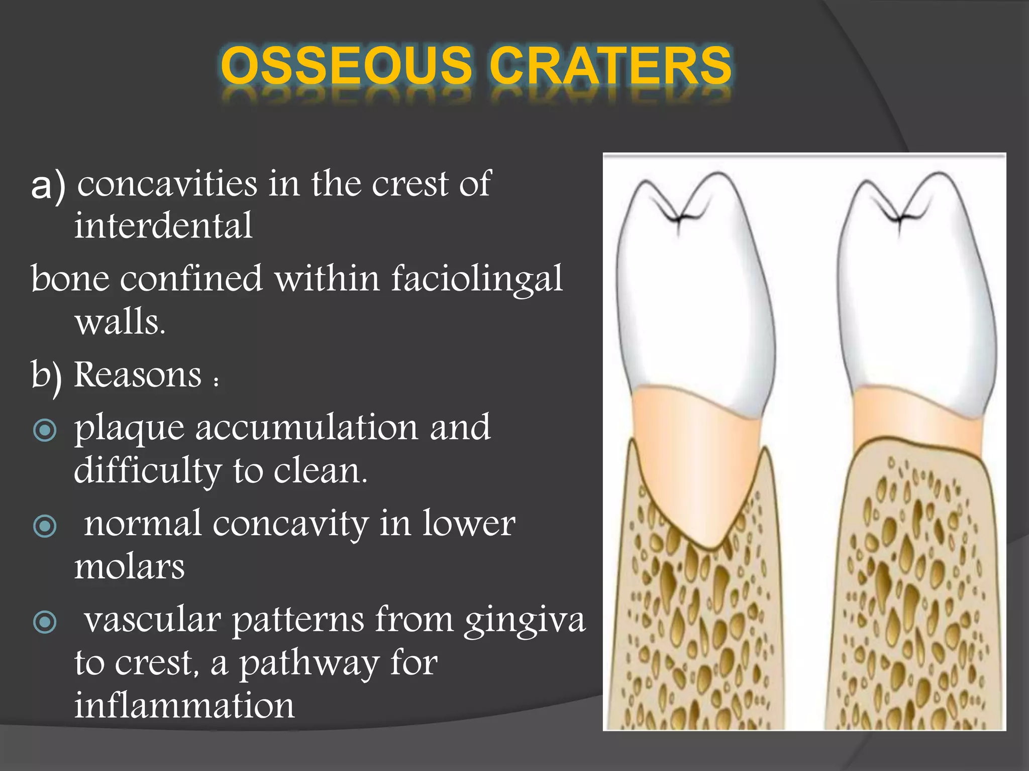 OSSEOUS CRATERS
a) concavities in the crest of
interdental
bone confined within faciolingal
walls.
b) Reasons :
 plaque accumulation and
difficulty to clean.
 normal concavity in lower
molars
 vascular patterns from gingiva
to crest, a pathway for
inflammation
 