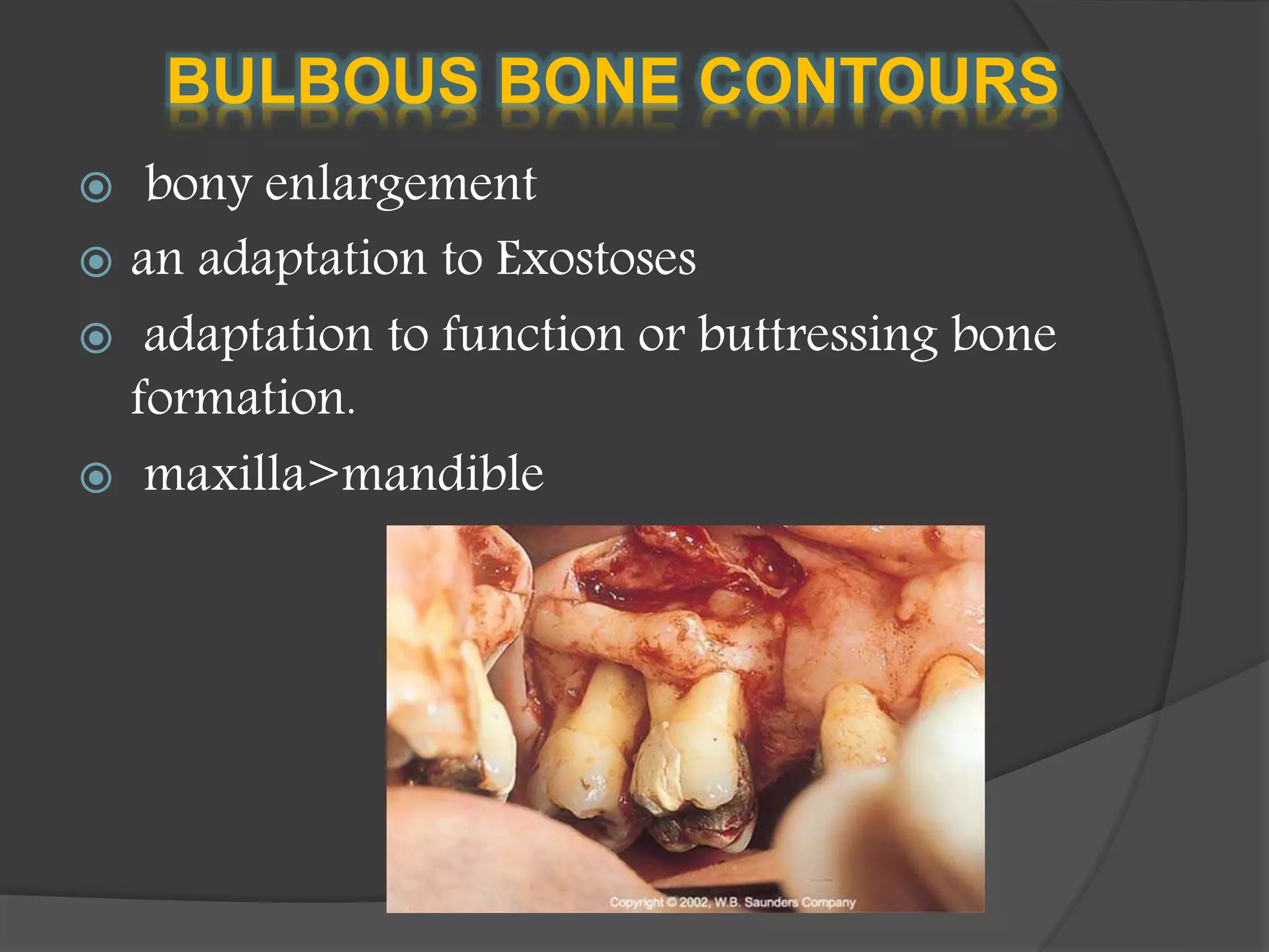 BULBOUS BONE CONTOURS
 bony enlargement
 an adaptation to Exostoses
 adaptation to function or buttressing bone
formation.
 maxilla>mandible
 