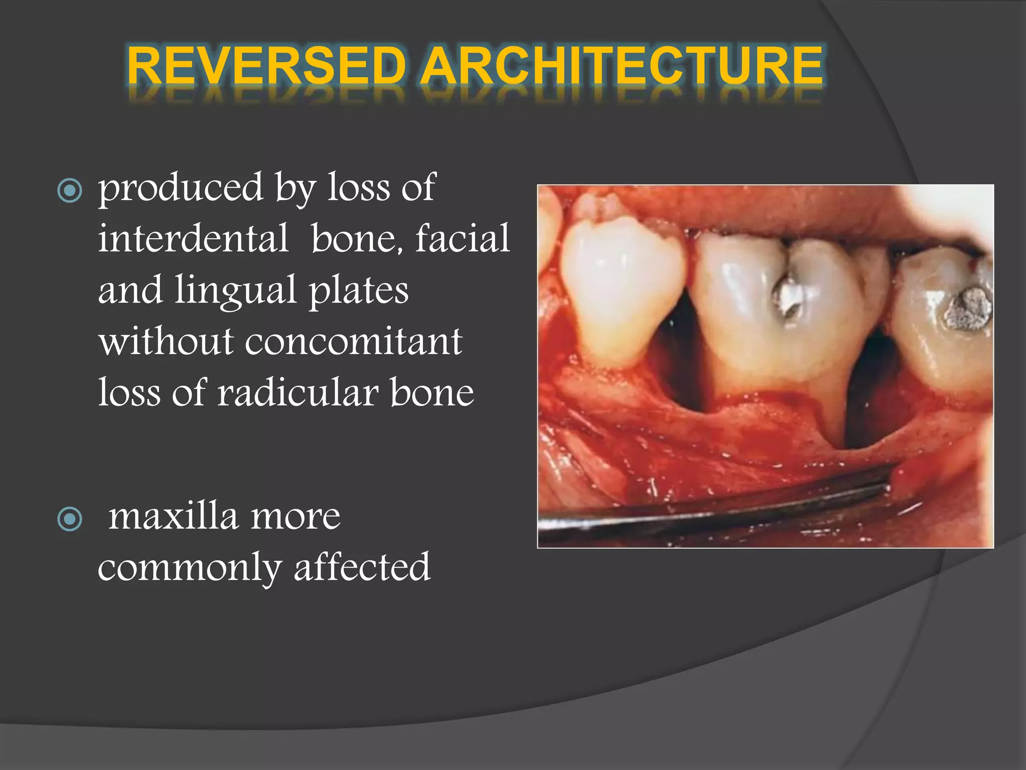 REVERSED ARCHITECTURE
 produced by loss of
interdental bone, facial
and lingual plates
without concomitant
loss of radicular bone
 maxilla more
commonly affected
 