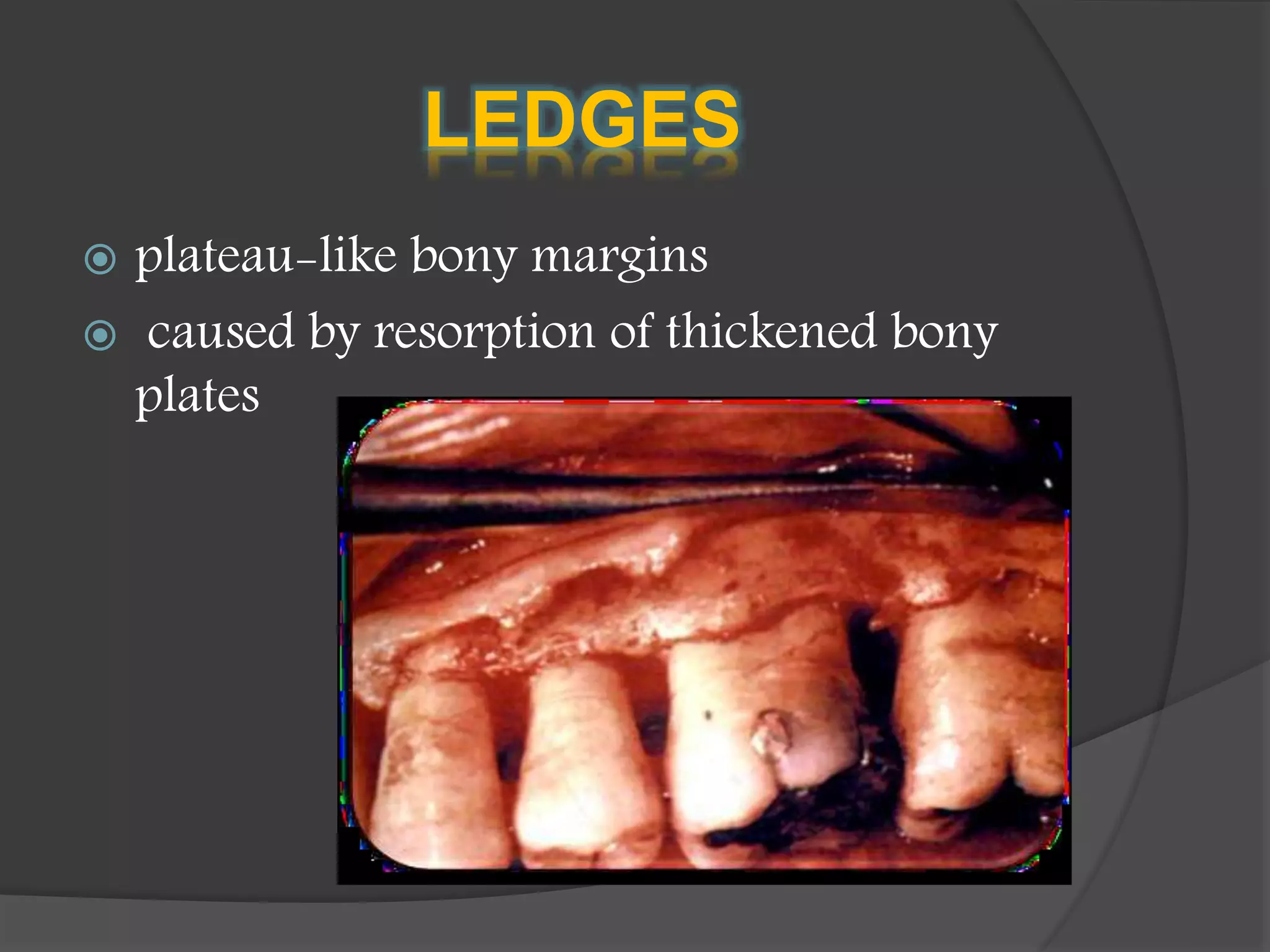 LEDGES
 plateau-like bony margins
 caused by resorption of thickened bony
plates
 