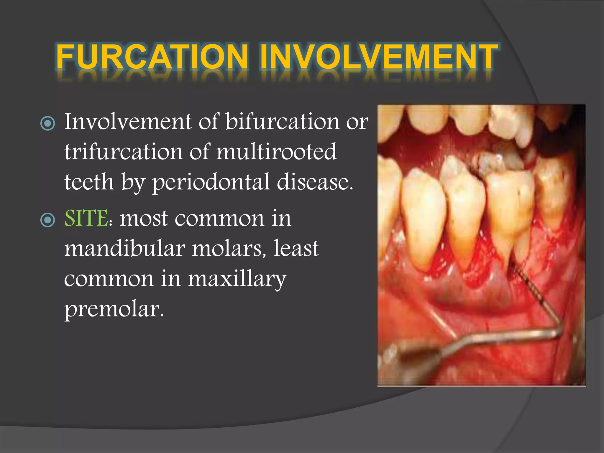 FURCATION INVOLVEMENT
 Involvement of bifurcation or
trifurcation of multirooted
teeth by periodontal disease.
 SITE: most common in
mandibular molars, least
common in maxillary
premolar.
 