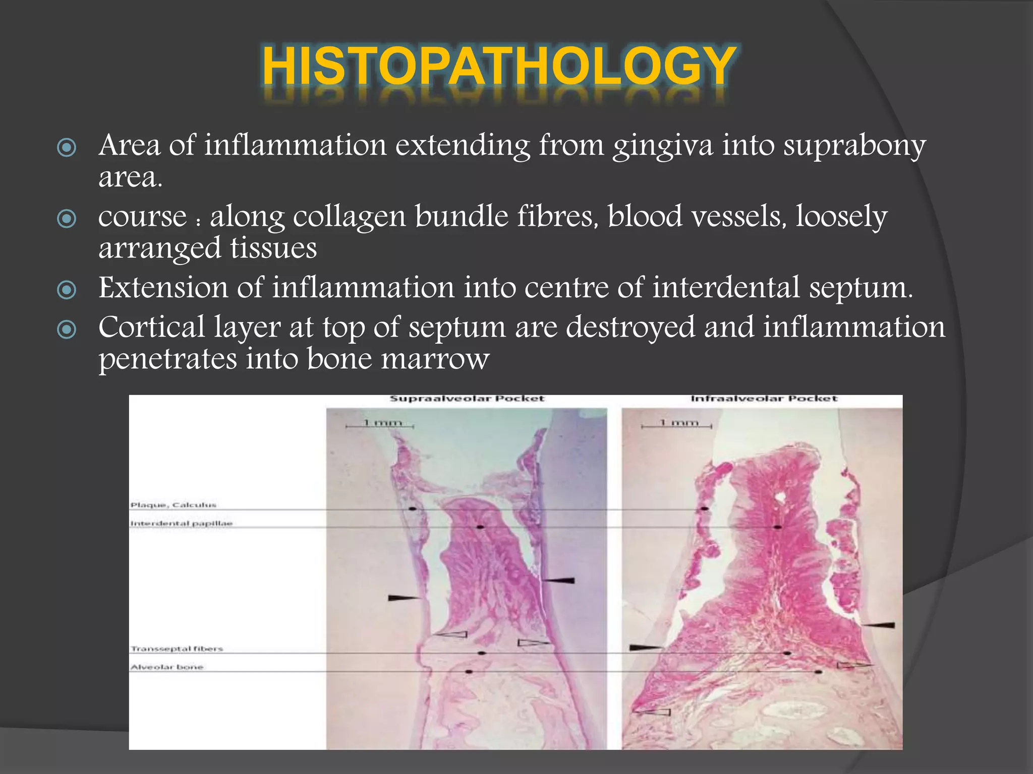 HISTOPATHOLOGY
 Area of inflammation extending from gingiva into suprabony
area.
 course : along collagen bundle fibres, blood vessels, loosely
arranged tissues
 Extension of inflammation into centre of interdental septum.
 Cortical layer at top of septum are destroyed and inflammation
penetrates into bone marrow
 