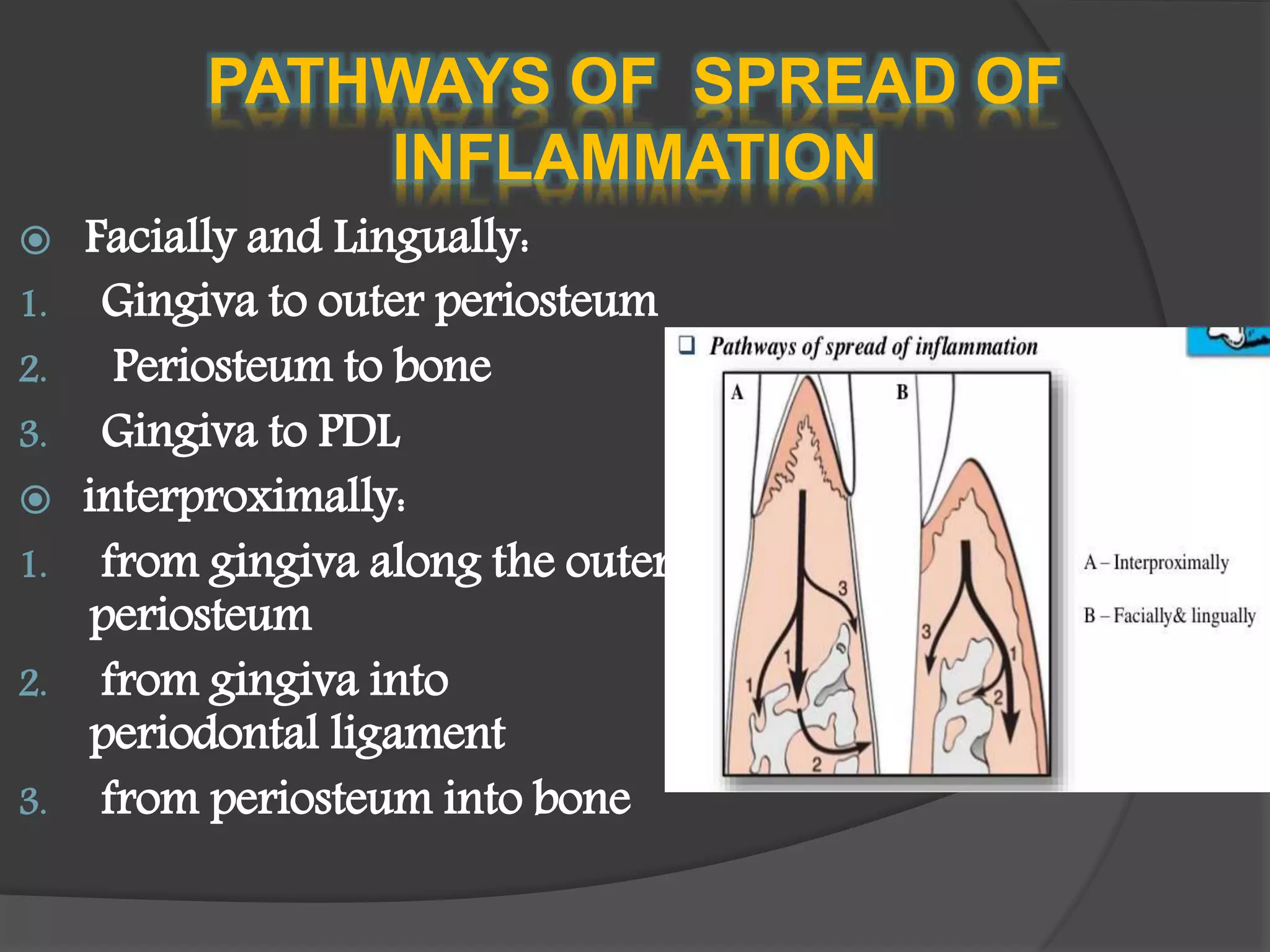 PATHWAYS OF SPREAD OF
INFLAMMATION
 Facially and Lingually:
1. Gingiva to outer periosteum
2. Periosteum to bone
3. Gingiva to PDL
 interproximally:
1. from gingiva along the outer
periosteum
2. from gingiva into
periodontal ligament
3. from periosteum into bone
 