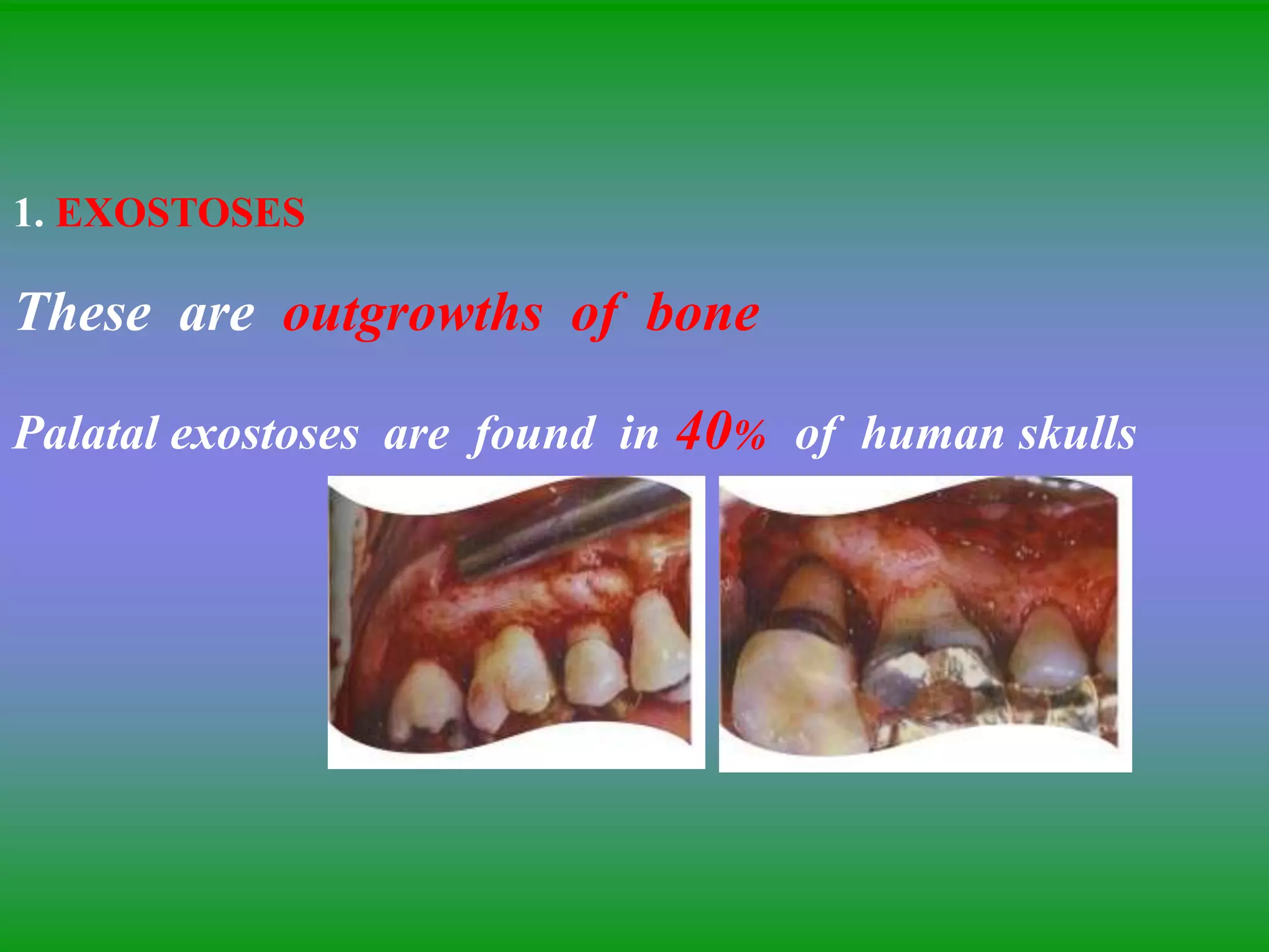 1. EXOSTOSES
These are outgrowths of bone
Palatal exostoses are found in 40% of human skulls
 