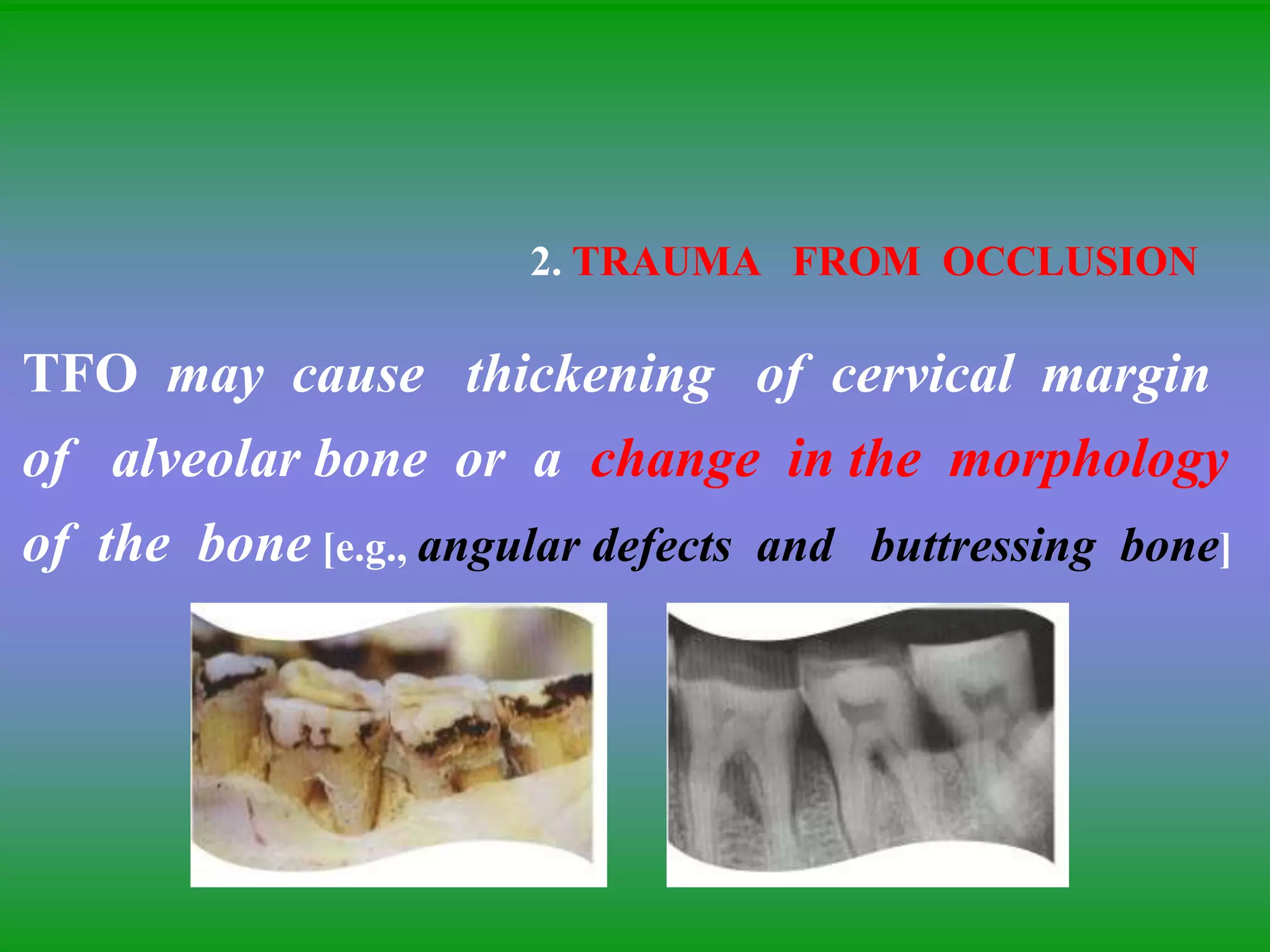 2. TRAUMA FROM OCCLUSION
TFO may cause thickening of cervical margin
of alveolar bone or a change in the morphology
of the bone [e.g., angular defects and buttressing bone]
 
