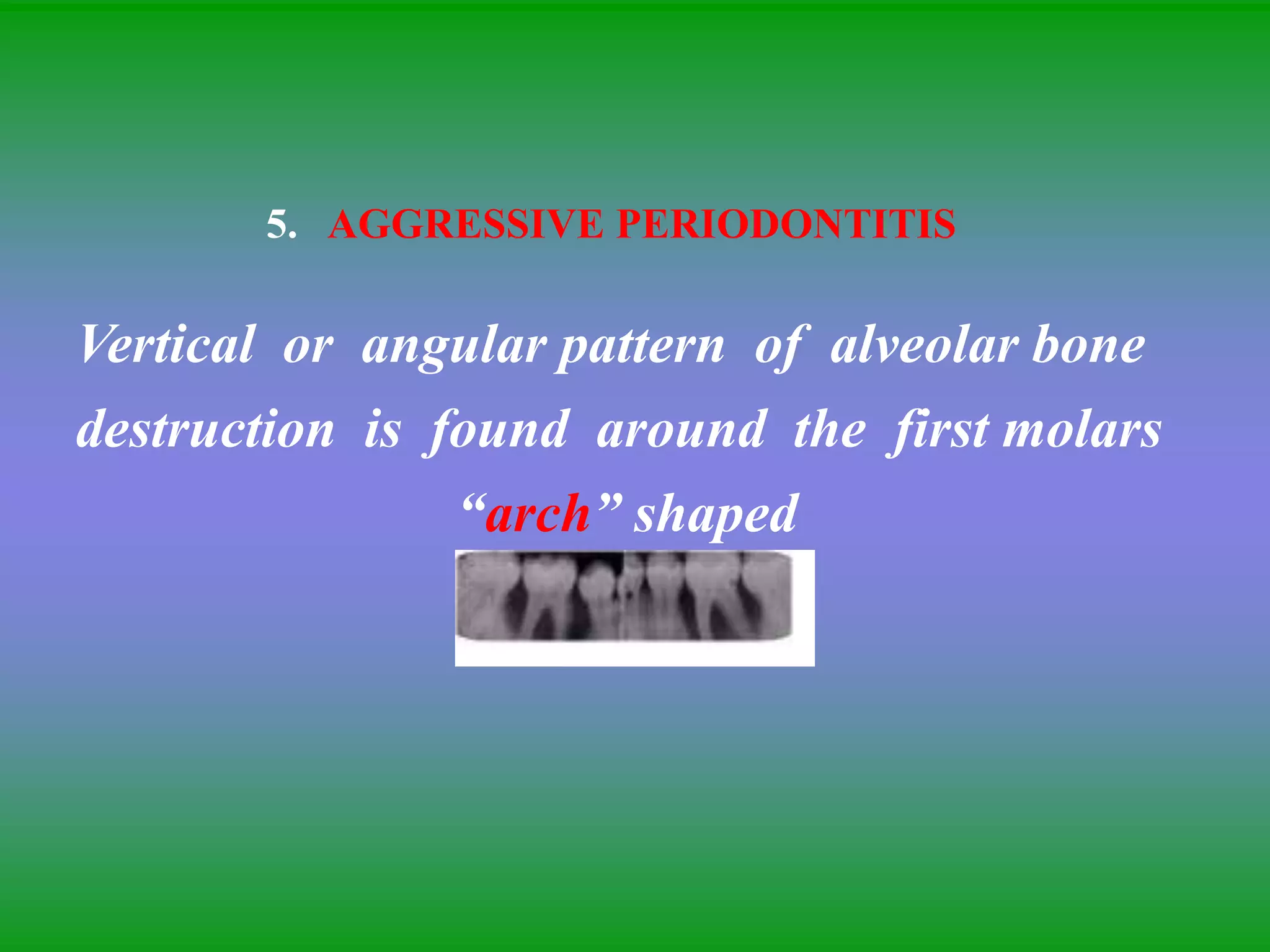 5. AGGRESSIVE PERIODONTITIS
Vertical or angular pattern of alveolar bone
destruction is found around the first molars
“arch” shaped
 