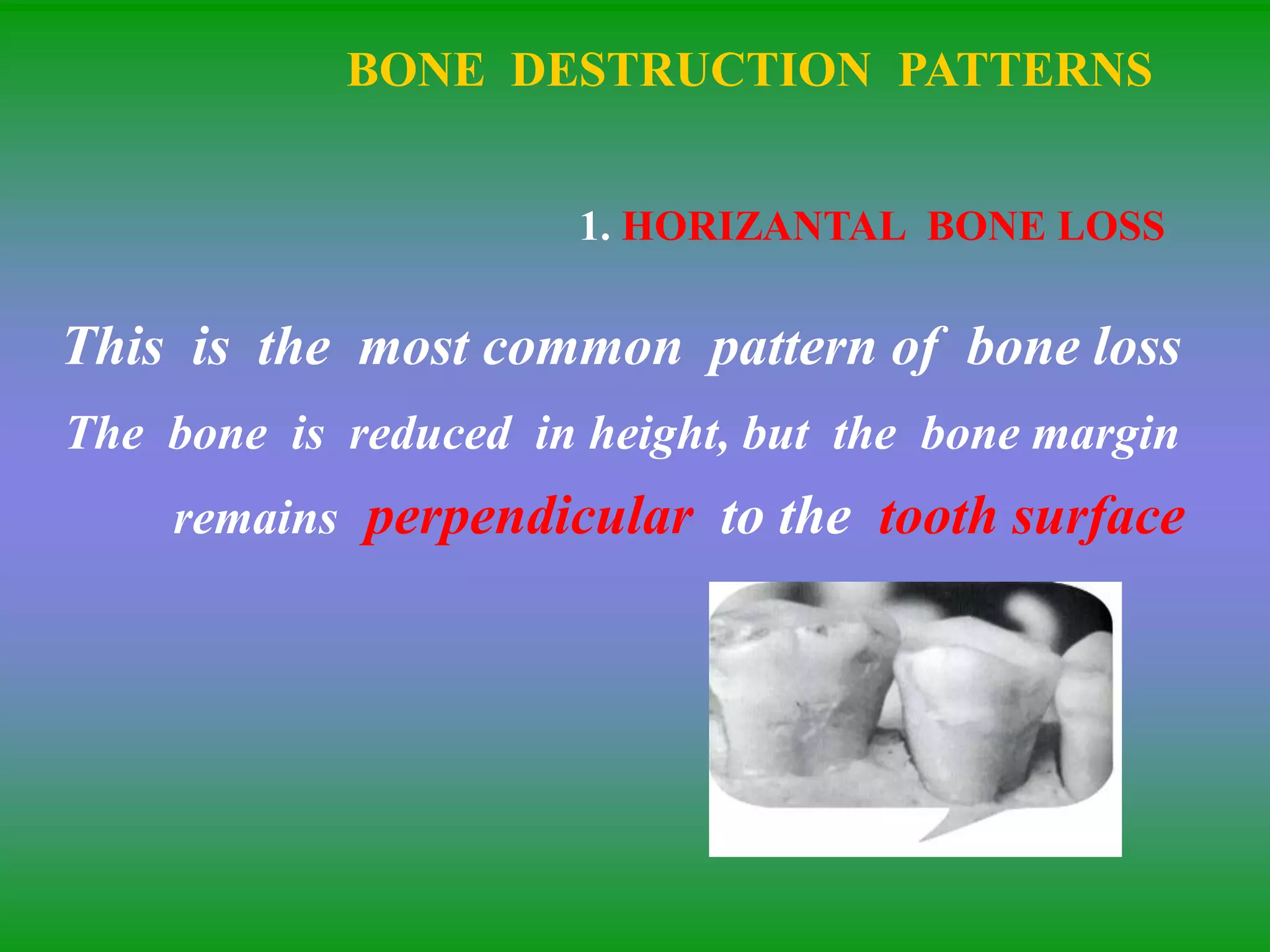 BONE DESTRUCTION PATTERNS
1. HORIZANTAL BONE LOSS
This is the most common pattern of bone loss
The bone is reduced in height, but the bone margin
remains perpendicular to the tooth surface
 