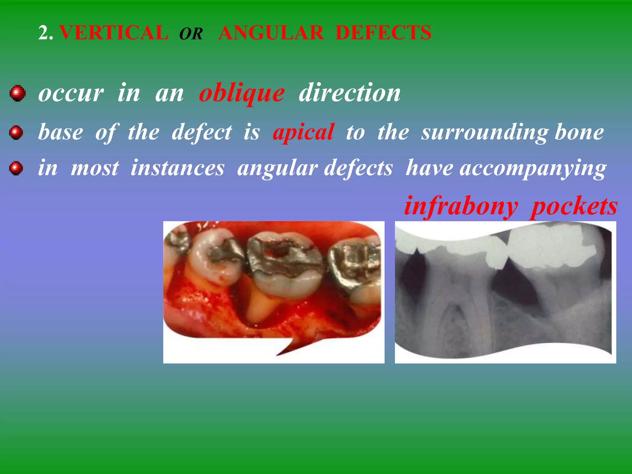 2. VERTICAL OR ANGULAR DEFECTS
occur in an oblique direction
base of the defect is apical to the surrounding bone
in most instances angular defects have accompanying
infrabony pockets
 