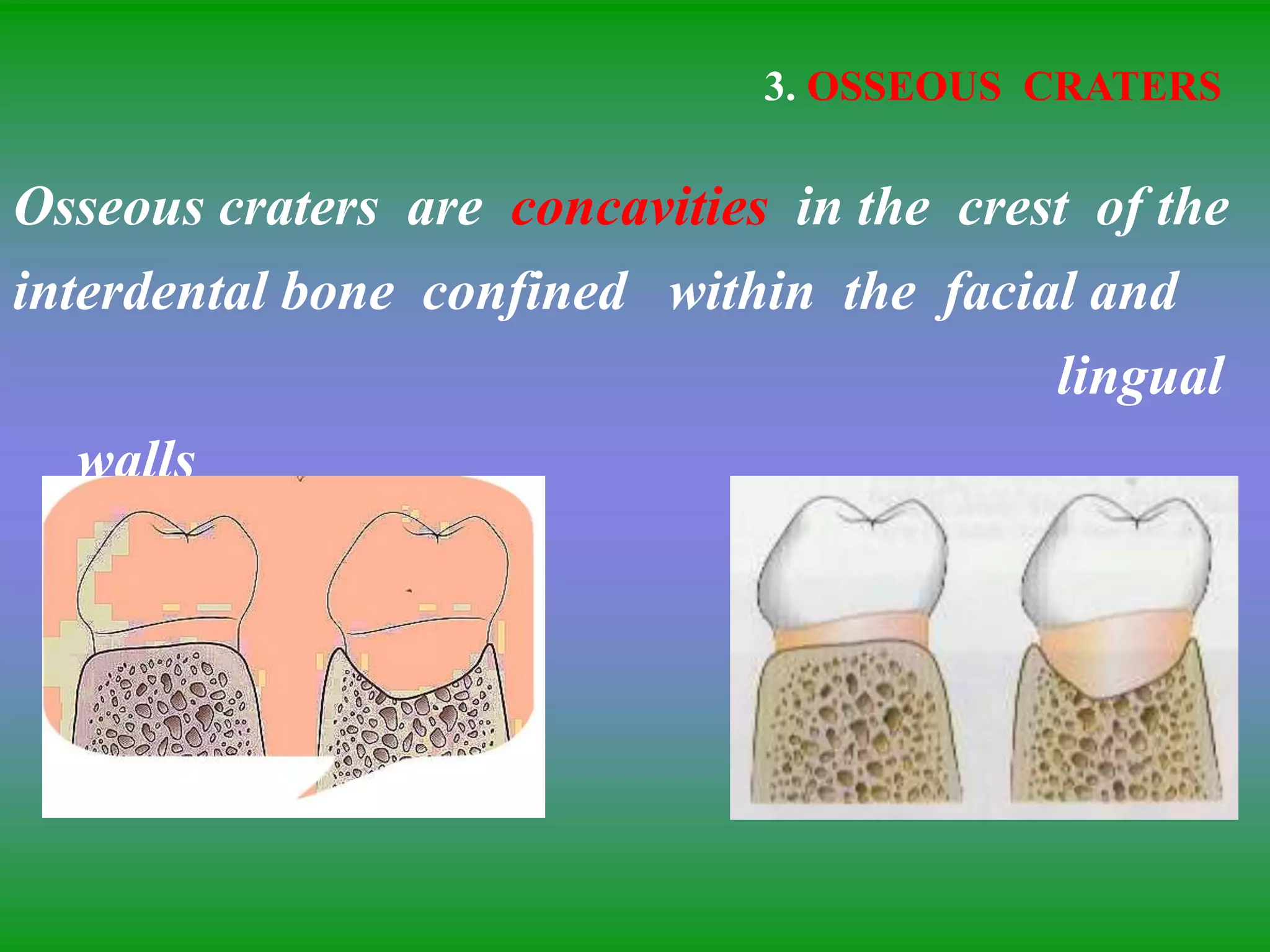 3. OSSEOUS CRATERS
Osseous craters are concavities in the crest of the
interdental bone confined within the facial and
lingual
walls
 
