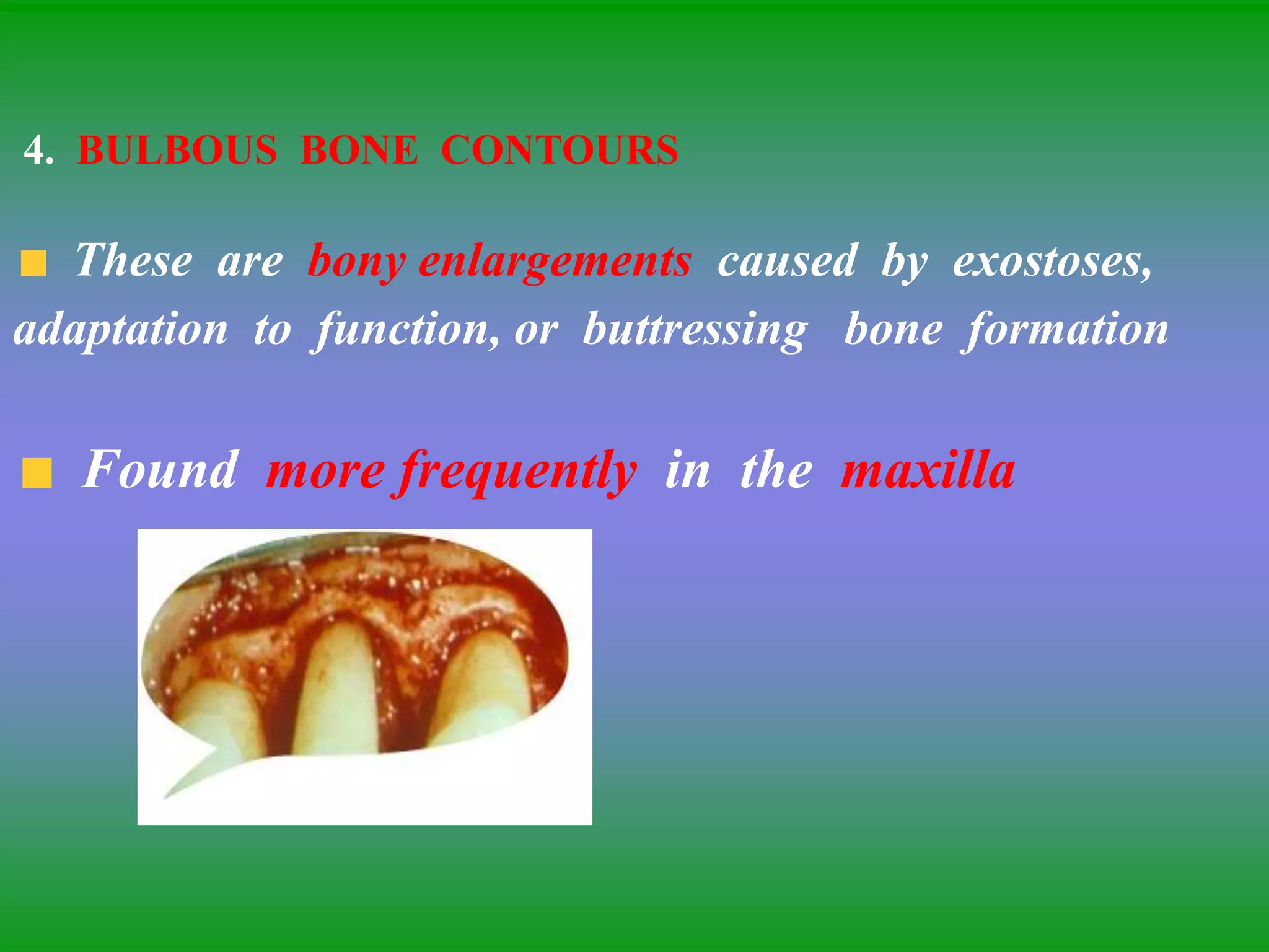 4. BULBOUS BONE CONTOURS
These are bony enlargements caused by exostoses,
adaptation to function, or buttressing bone formation
Found more frequently in the maxilla
 