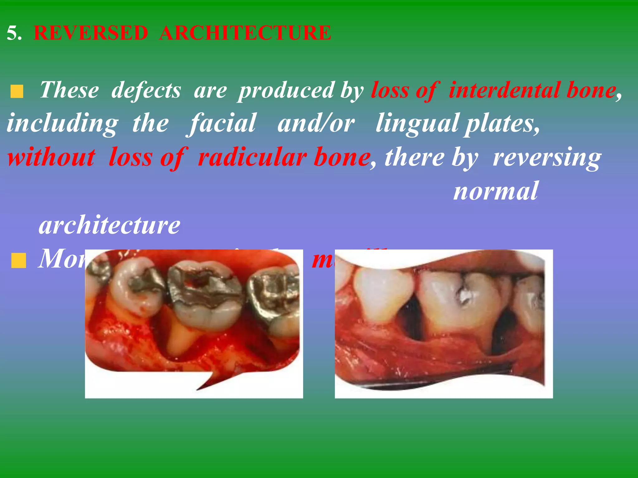 5. REVERSED ARCHITECTURE
These defects are produced by loss of interdental bone,
including the facial and/or lingual plates,
without loss of radicular bone, there by reversing
normal
architecture
More common in the maxilla
 