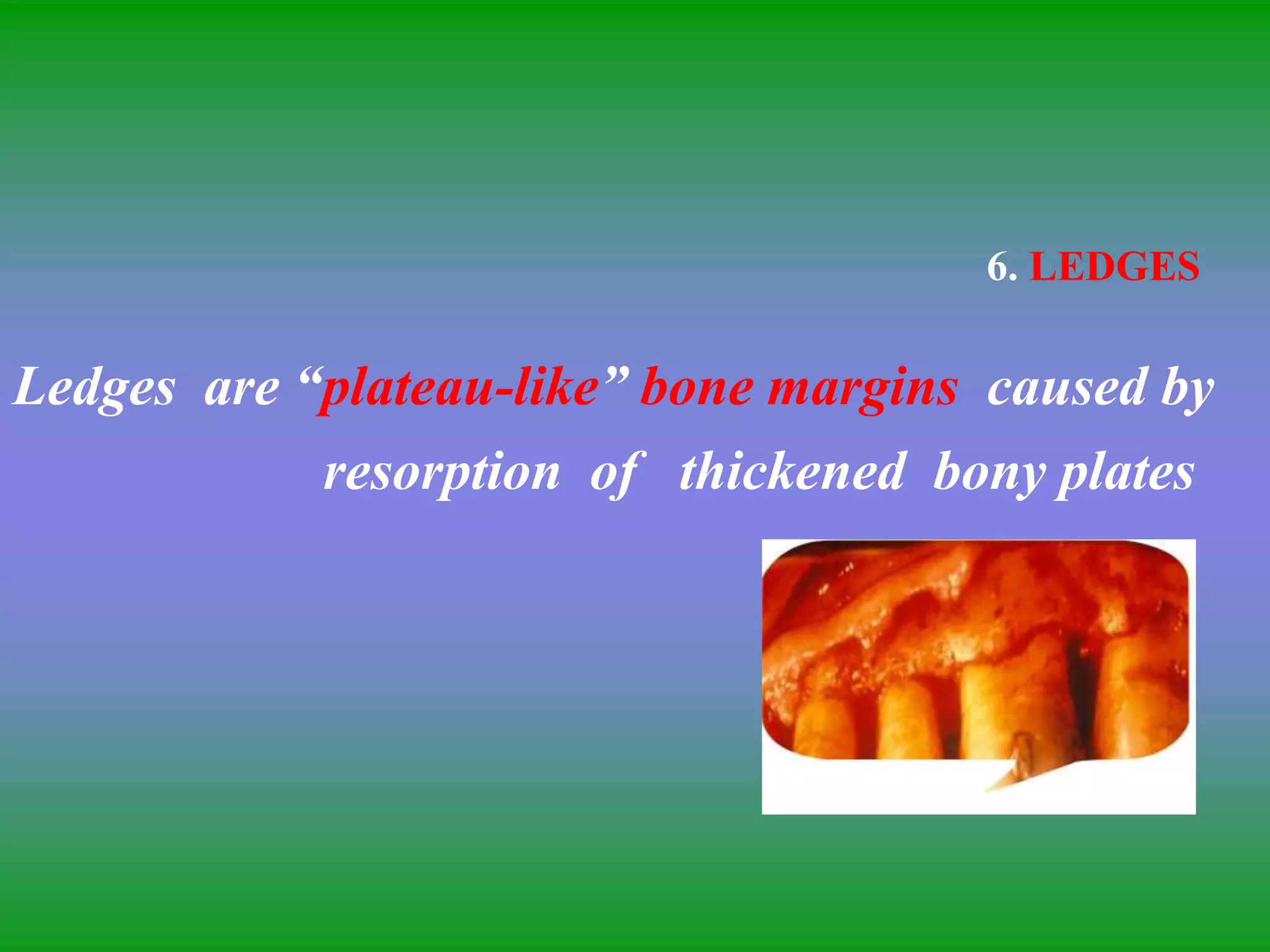 6. LEDGES
Ledges are “plateau-like” bone margins caused by
resorption of thickened bony plates
 
