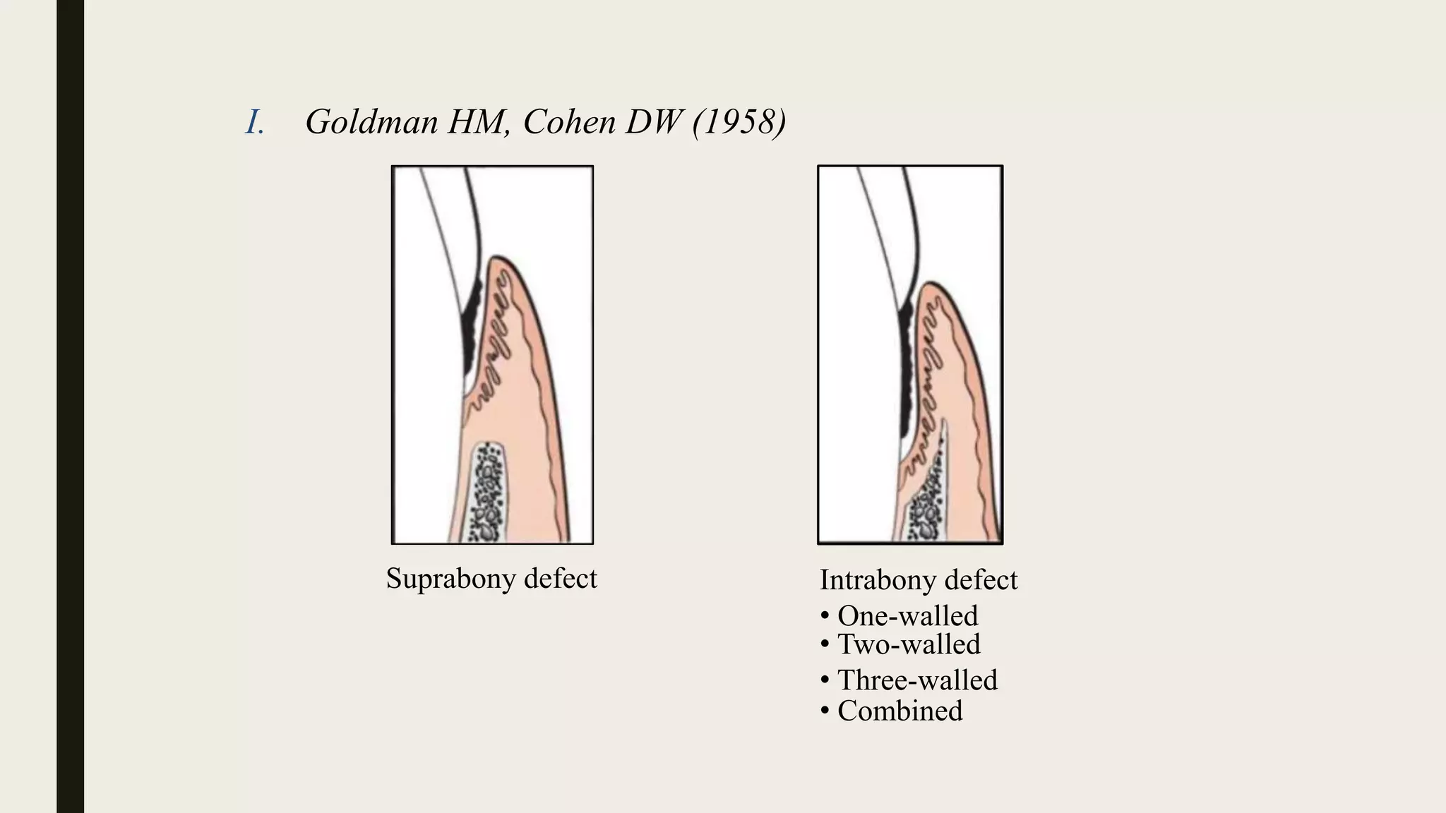 I. Goldman HM, Cohen DW (1958)
Suprabony defect Intrabony defect
• One-walled
• Two-walled
• Three-walled
• Combined
 