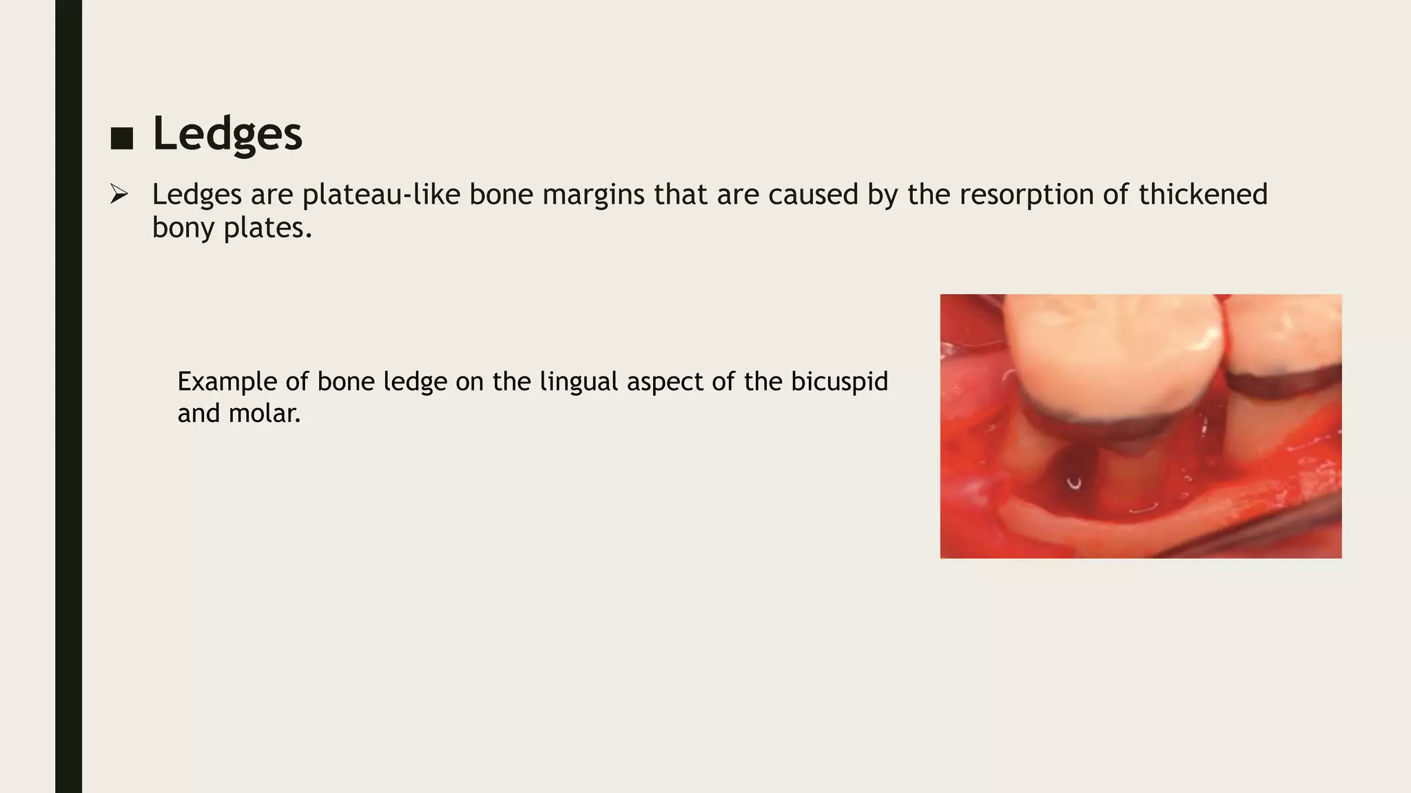 ■ Ledges
 Ledges are plateau-like bone margins that are caused by the resorption of thickened
bony plates.
Example of bone ledge on the lingual aspect of the bicuspid
and molar.
 