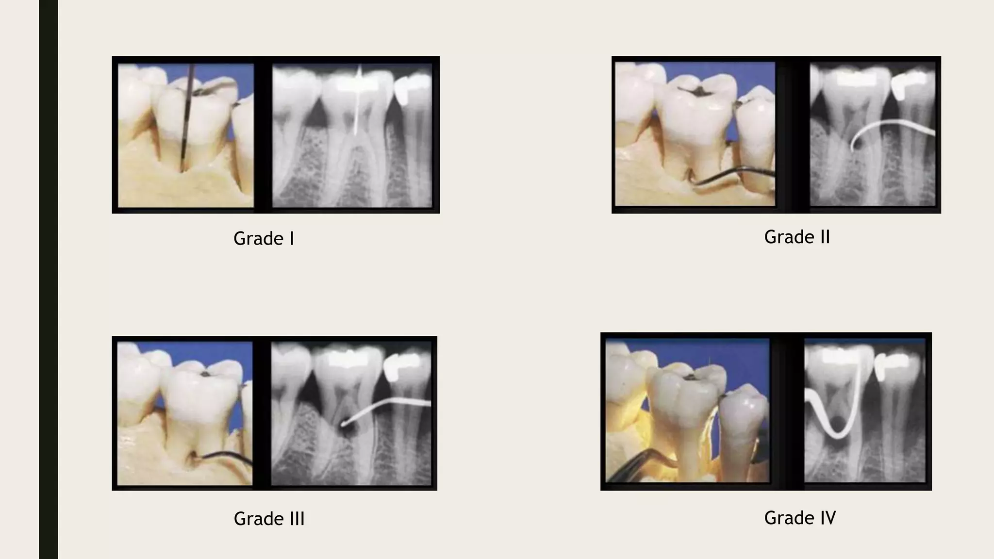 Grade I Grade II
Grade IV
Grade III
 