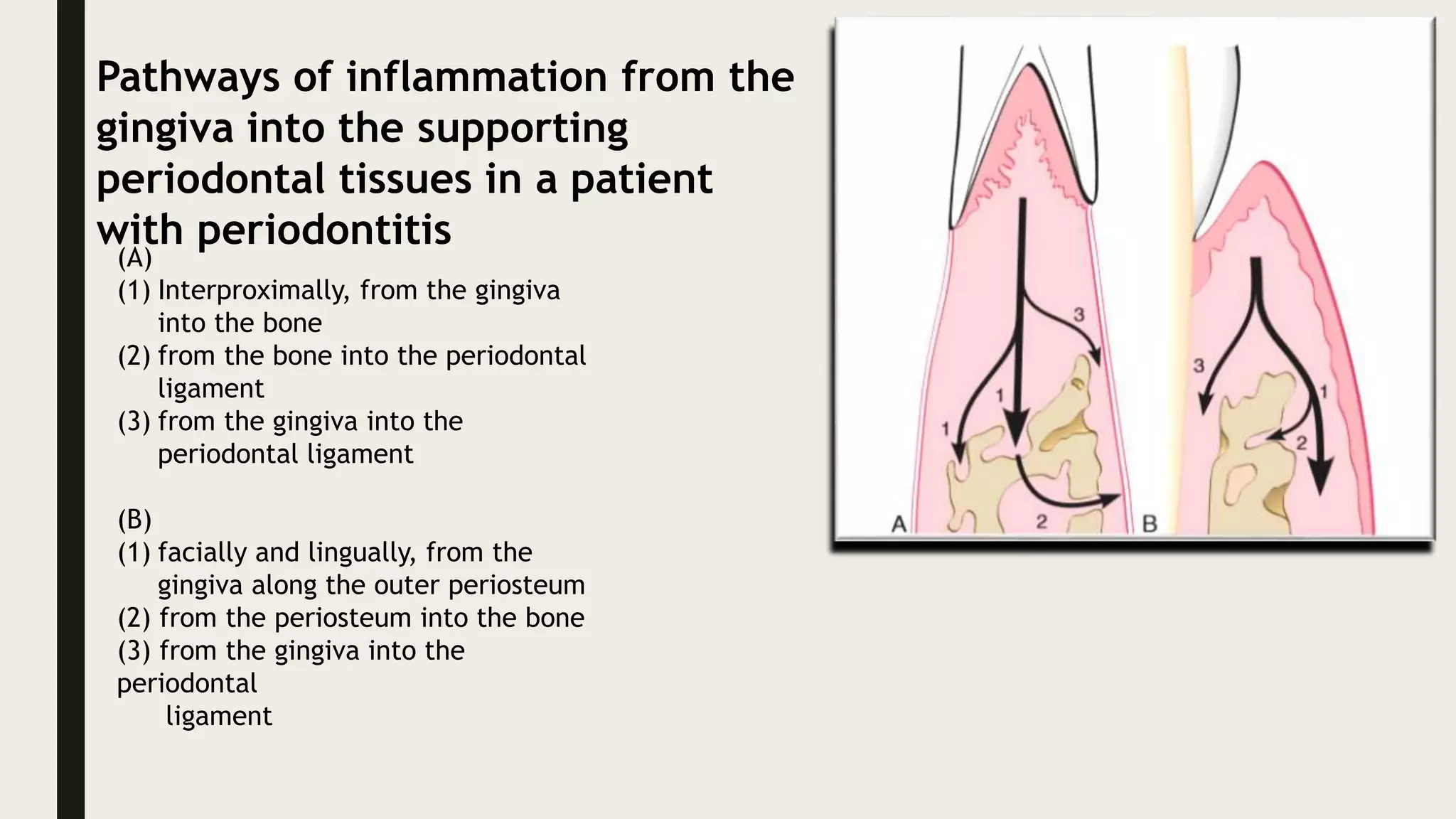 Pathways of inflammation from the
gingiva into the supporting
periodontal tissues in a patient
with periodontitis
(A)
(1) Interproximally, from the gingiva
into the bone
(2) from the bone into the periodontal
ligament
(3) from the gingiva into the
periodontal ligament
(B)
(1) facially and lingually, from the
gingiva along the outer periosteum
(2) from the periosteum into the bone
(3) from the gingiva into the
periodontal
ligament
 