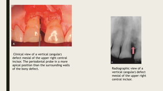 Clinical view of a vertical (angular)
defect mesial of the upper right central
incisor. The periodontal probe in a more
apical position than the surrounding walls
of the bony defect. Radiographic view of a
vertical (angular) defect
mesial of the upper right
central incisor.
 